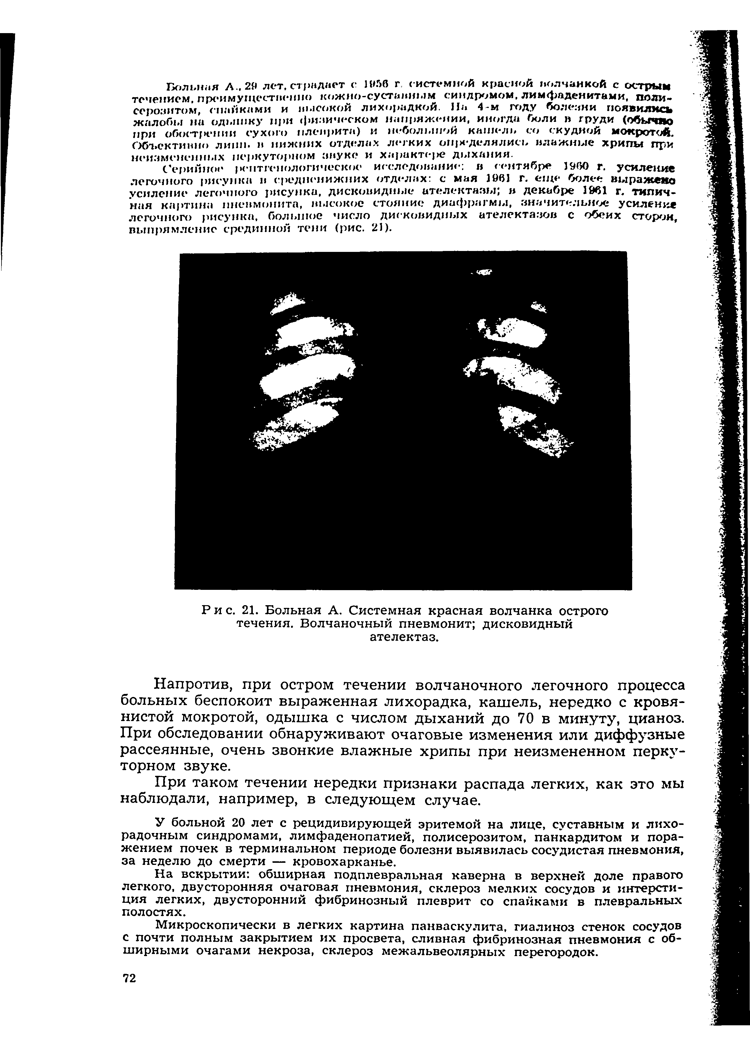 Рис. 21. Больная А. Системная красная волчанка острого течения. Волчаночный пневмонит дисковидный ателектаз.