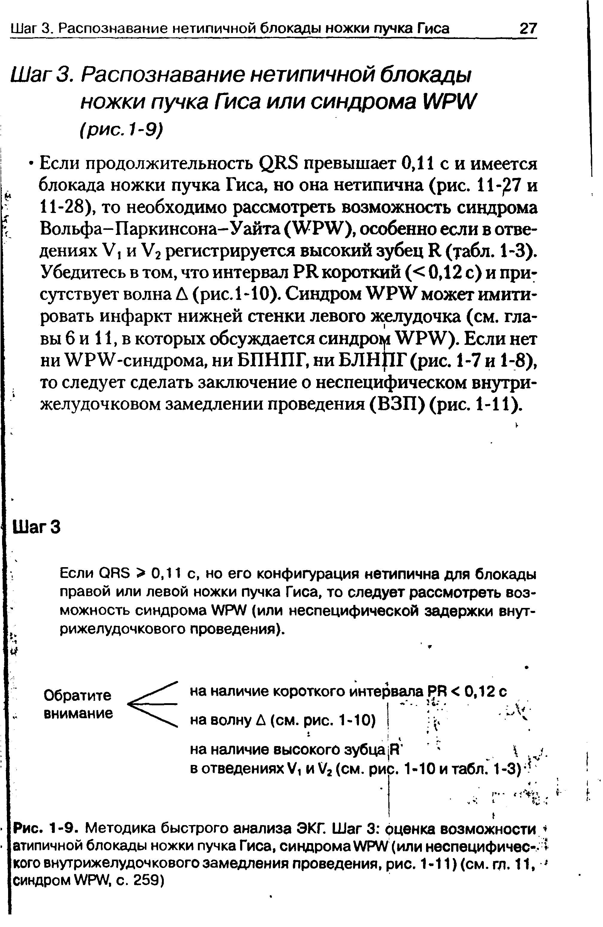 Рис. 1-9. Методика быстрого анализа ЭКГ. Шаг 3 оценка возможности/ атипичной блокады ножки пучка Гиса, синдрома NP (или неспецифичес---кого внутрижелудочкового замедления проведения, рис. 1-11)(см.гл. 11, синдром ЩРЩ, с. 259)...