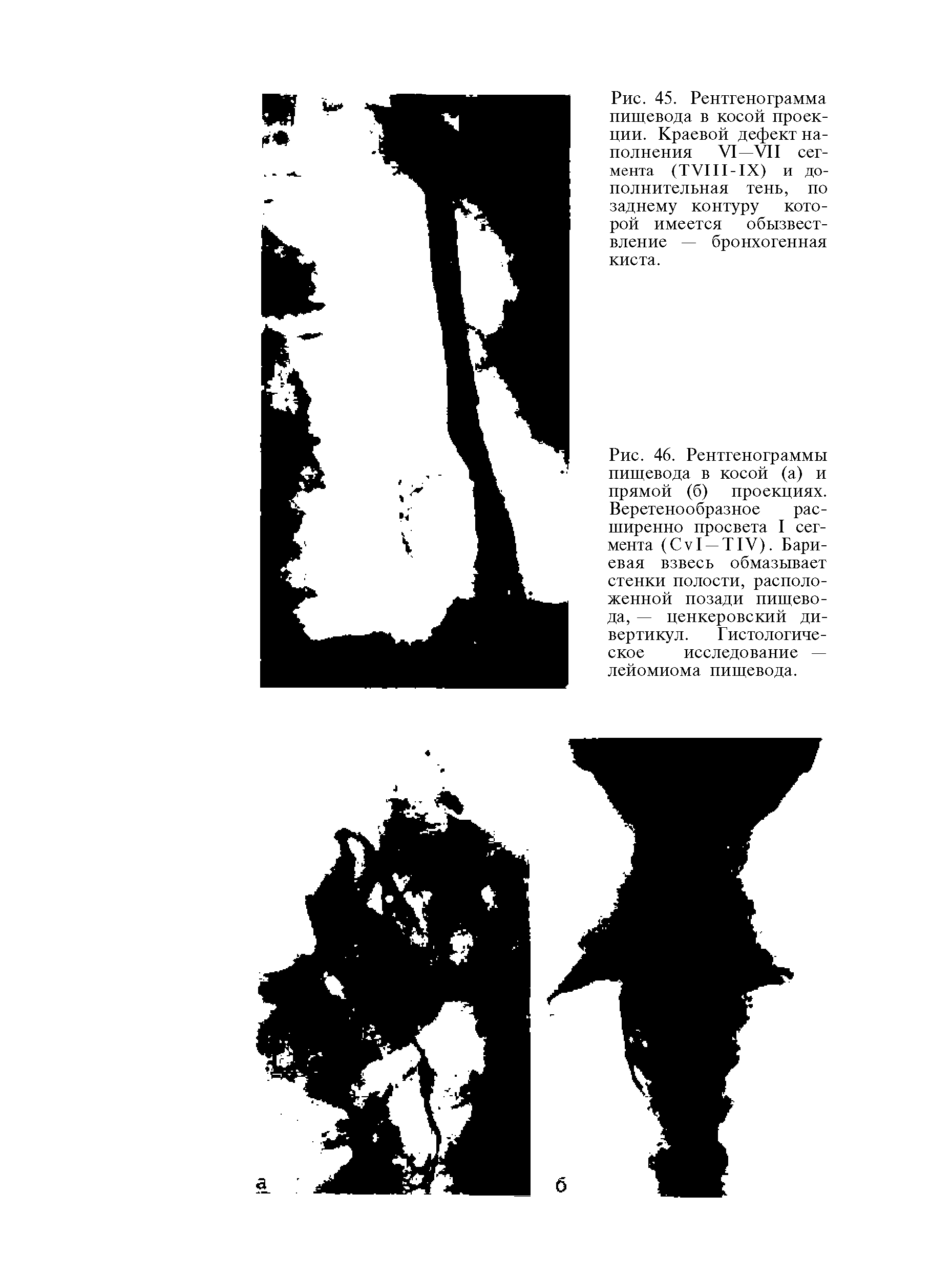 Рис. 46. Рентгенограммы пищевода в косой (а) и прямой (б) проекциях. Веретенообразное расширенно просвета I сегмента (СVI — Т1У). Бариевая взвесь обмазывает стенки полости, расположенной позади пищевода, — ценкеровский дивертикул. Гистологическое исследование — лейомиома пищевода.