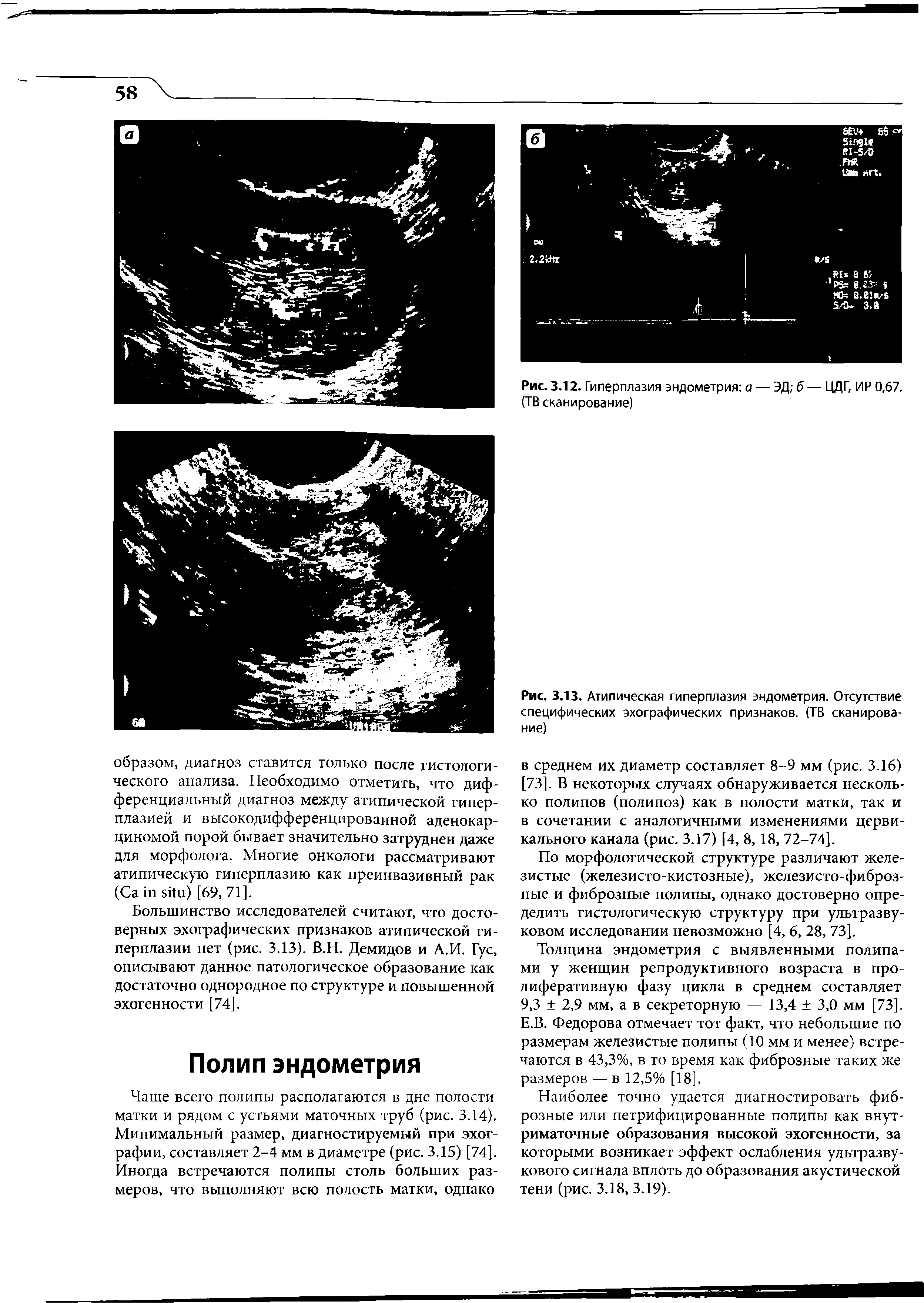 Рис. 3.13. Атипическая гиперплазия эндометрия. Отсутствие специфических эхографических признаков. (ТВ сканирование)...