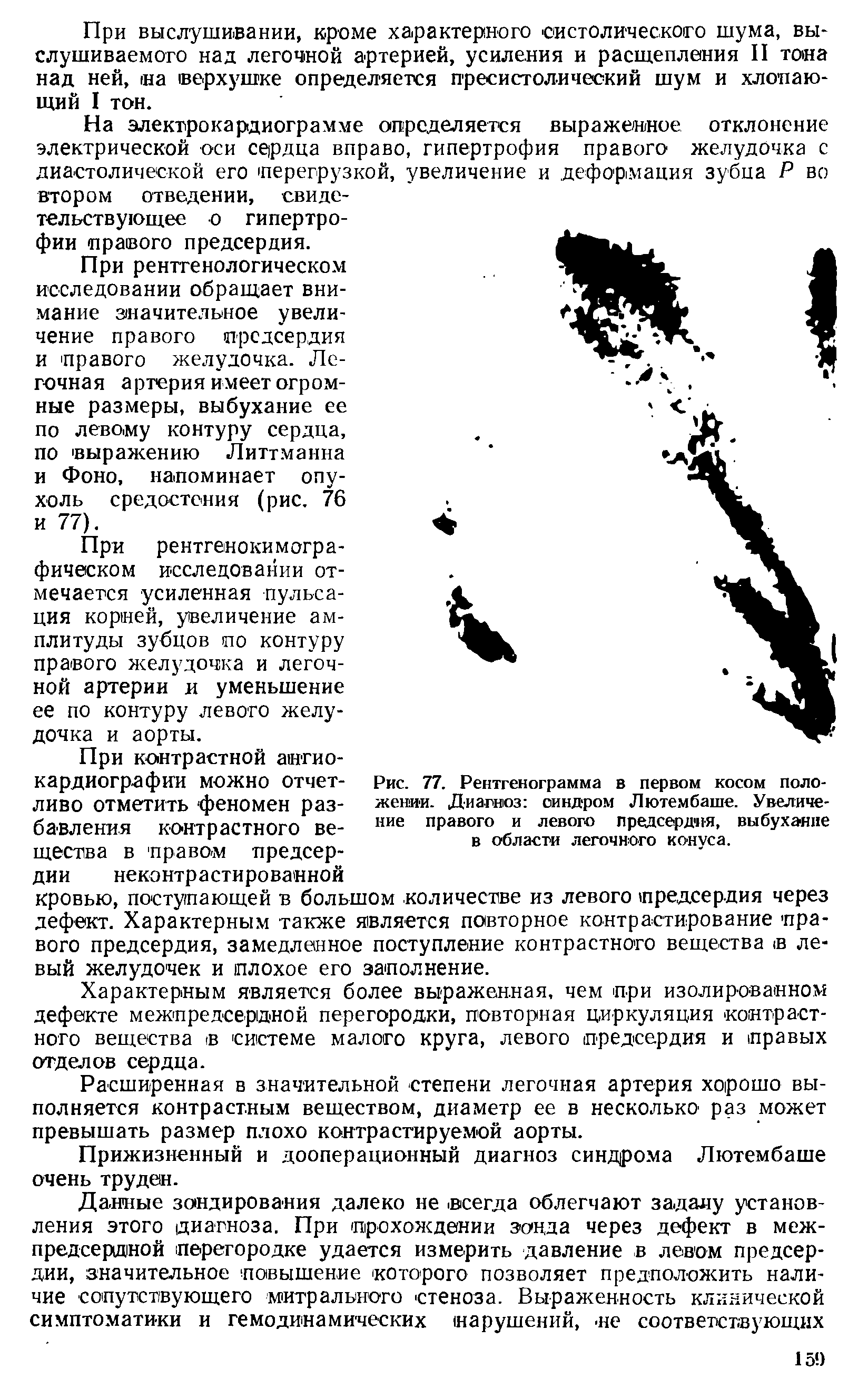 Рис. 77. Рентгенограмма в первом косом положении. Диагноз синдром Лютембаше. Увеличение правого и левого предсердия, выбухание в области легочного конуса.