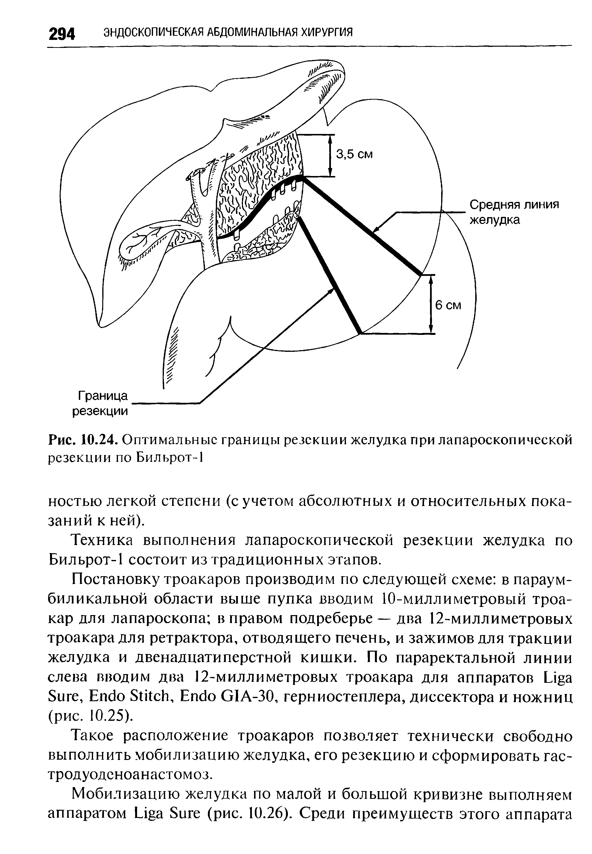 Рис. 10.24. Оптимальные границы резекции желудка при лапароскопической резекции по Бильрот-1...