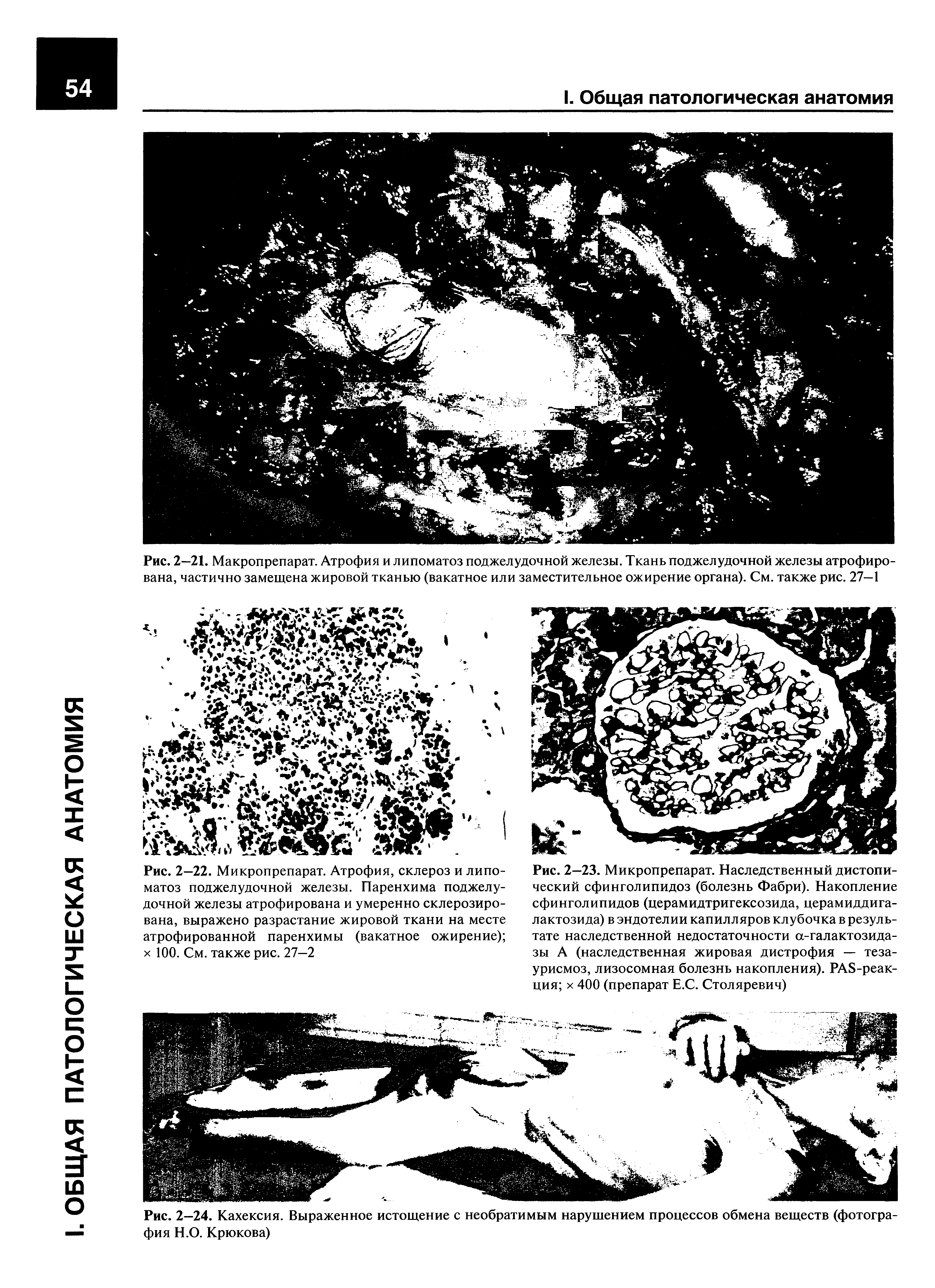 Рис. 2—23. Микропрепарат. Наследственный дистопи-ческий сфинголипидоз (болезнь Фабри). Накопление сфинголипидов (церамидтригексозида, церамиддигалактозида) в эндотелии капилляров клубочка в результате наследственной недостаточности а-галактозида-зы А (наследственная жировая дистрофия — теза-урисмоз, лизосомная болезнь накопления). РА8-реак-ция х 400 (препарат Е.С. Столяревич)...