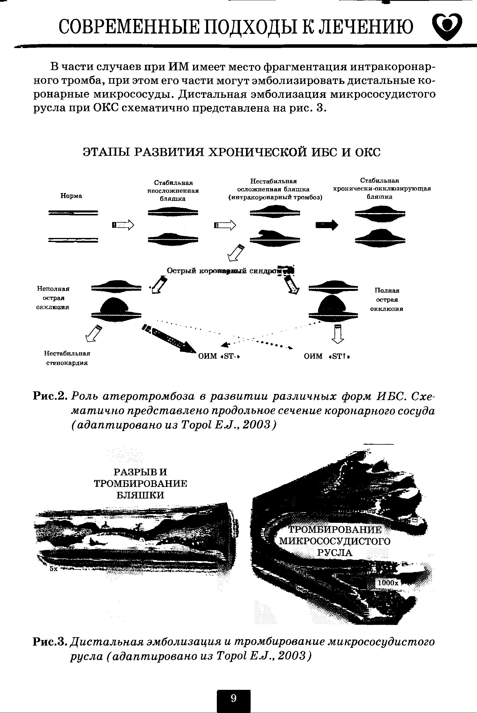 Рис.2. Роль атеротромбоза в развитии различных форм ИБС. Схематично представлено продольное сечение коронарного сосуда (адаптировано из T E.J., 2003)...