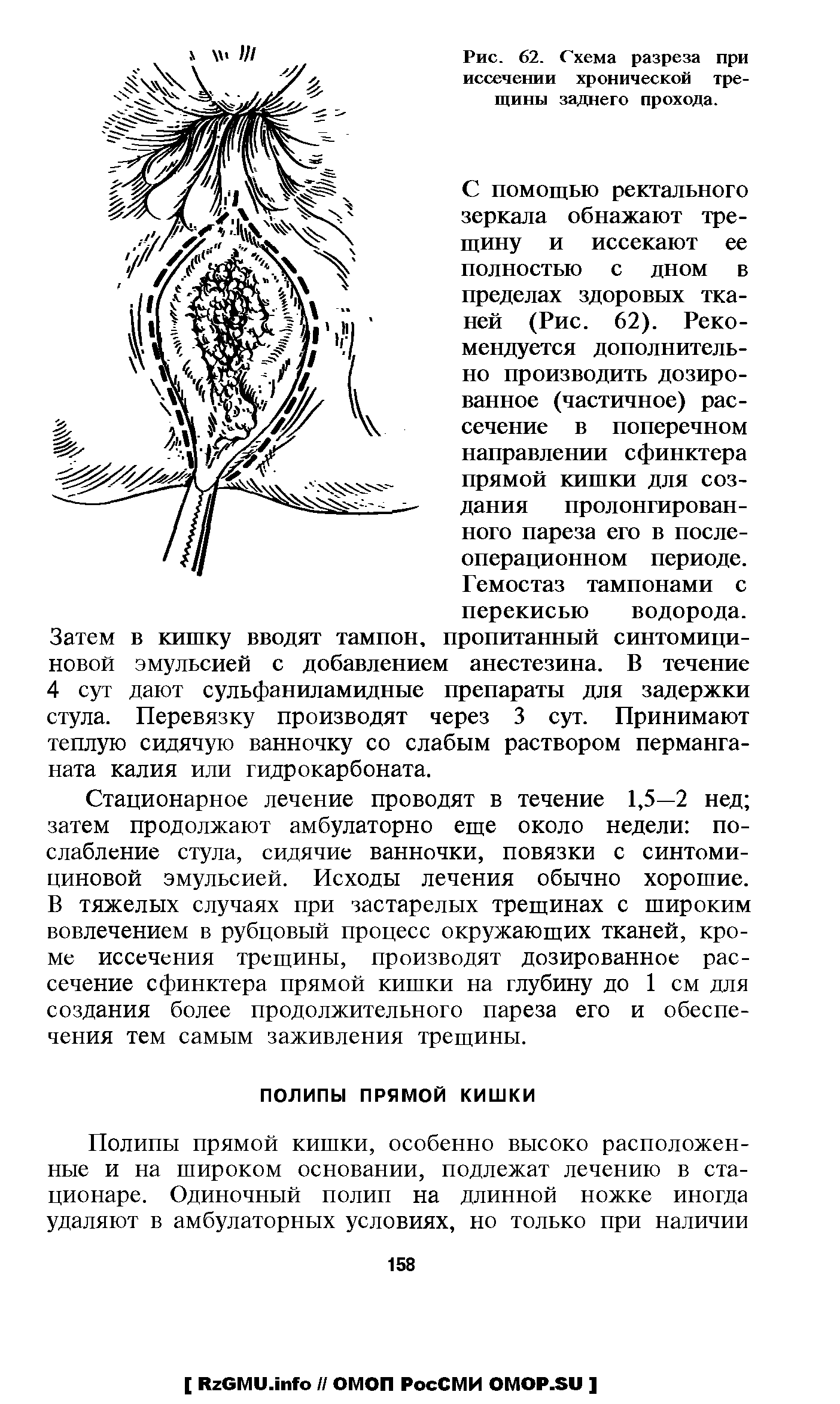 Рис. 62. Схема разреза при иссечении хронической трещины заднего прохода.