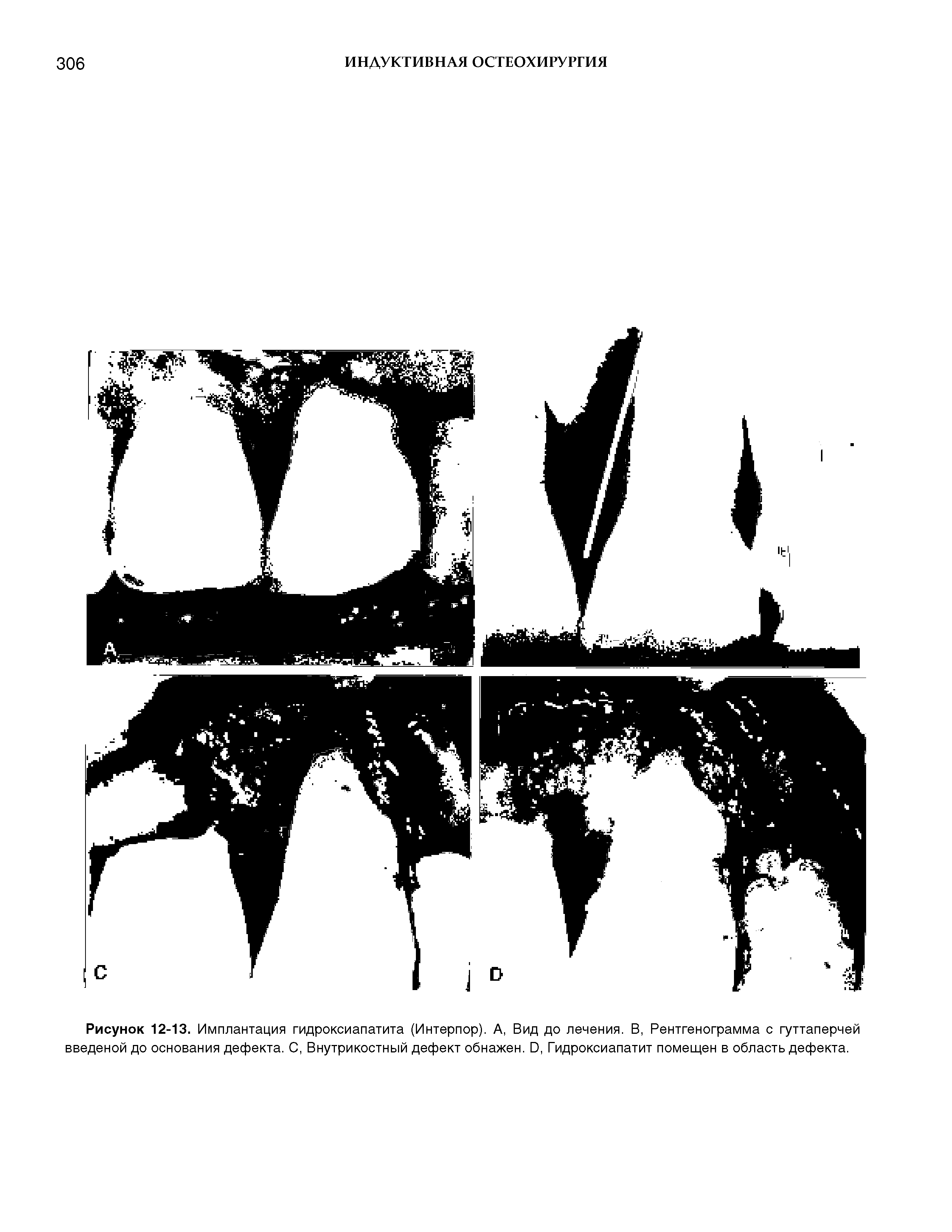 Рисунок 12-13. Имплантация гидроксиапатита (Интерпор). А, Вид до лечения. В, Рентгенограмма с гуттаперчей введеной до основания дефекта. С, Внутрикостный дефект обнажен. О, Гидроксиапатит помещен в область дефекта.