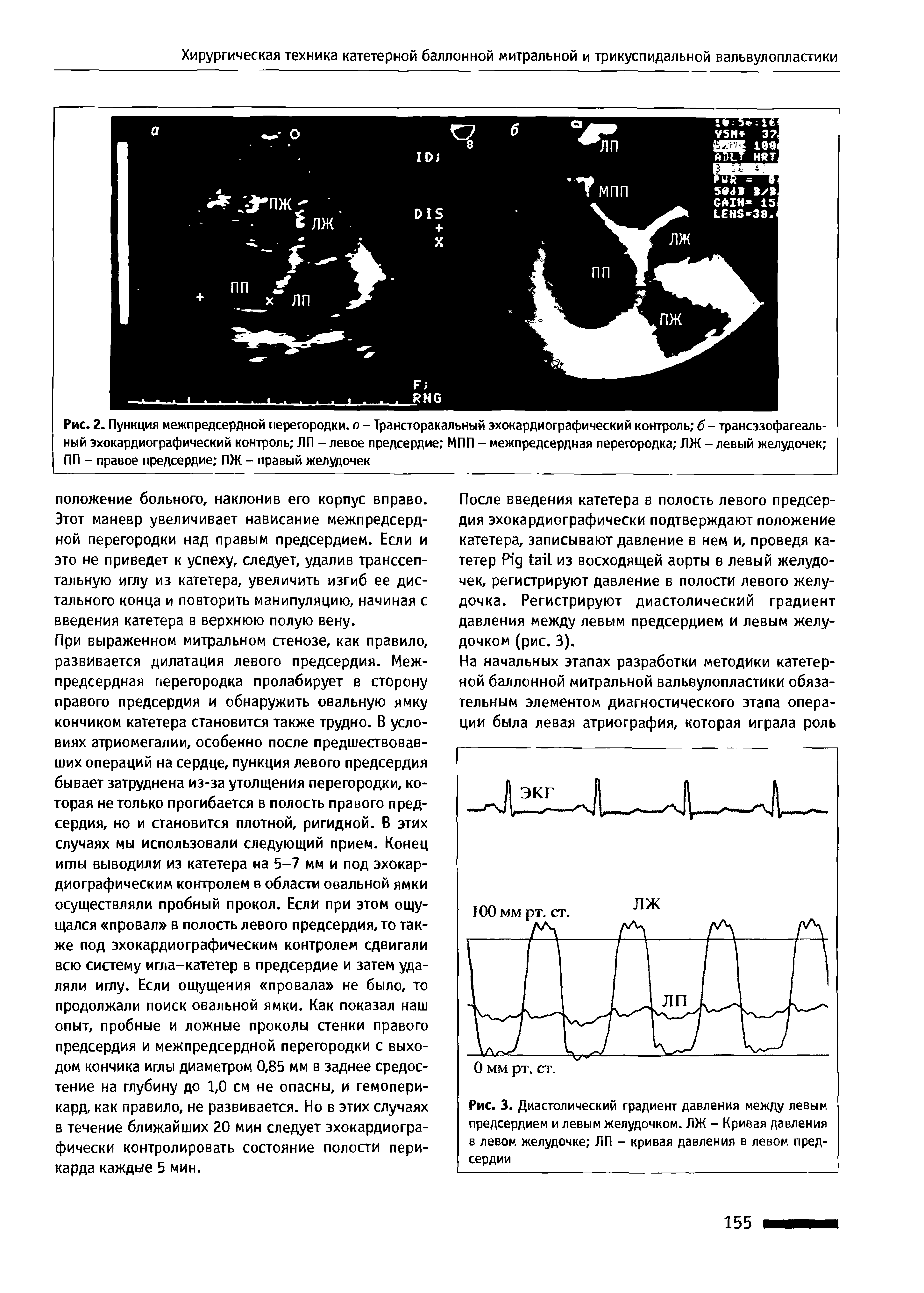 Рис. 2. Пункция межпредсердной перегородки, а - Трансторакальный эхокардиографический контроль б - трансэзофагеаль-ный эхокардиографический контроль ЛП - левое предсердие МПП - межпредсердная перегородка ЛЖ - левый желудочек ПП - правое предсердие ПЖ - правый желудочек...