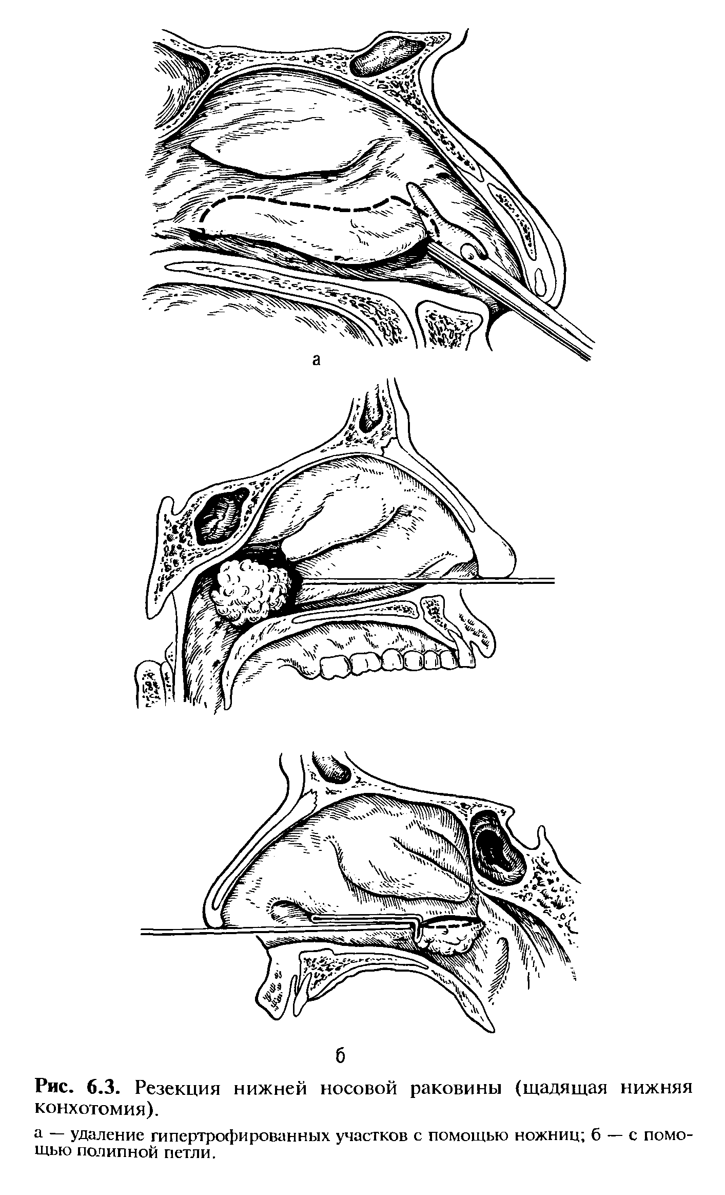 Рис. 6.3. Резекция нижней носовой раковины (щадящая нижняя конхотомия).