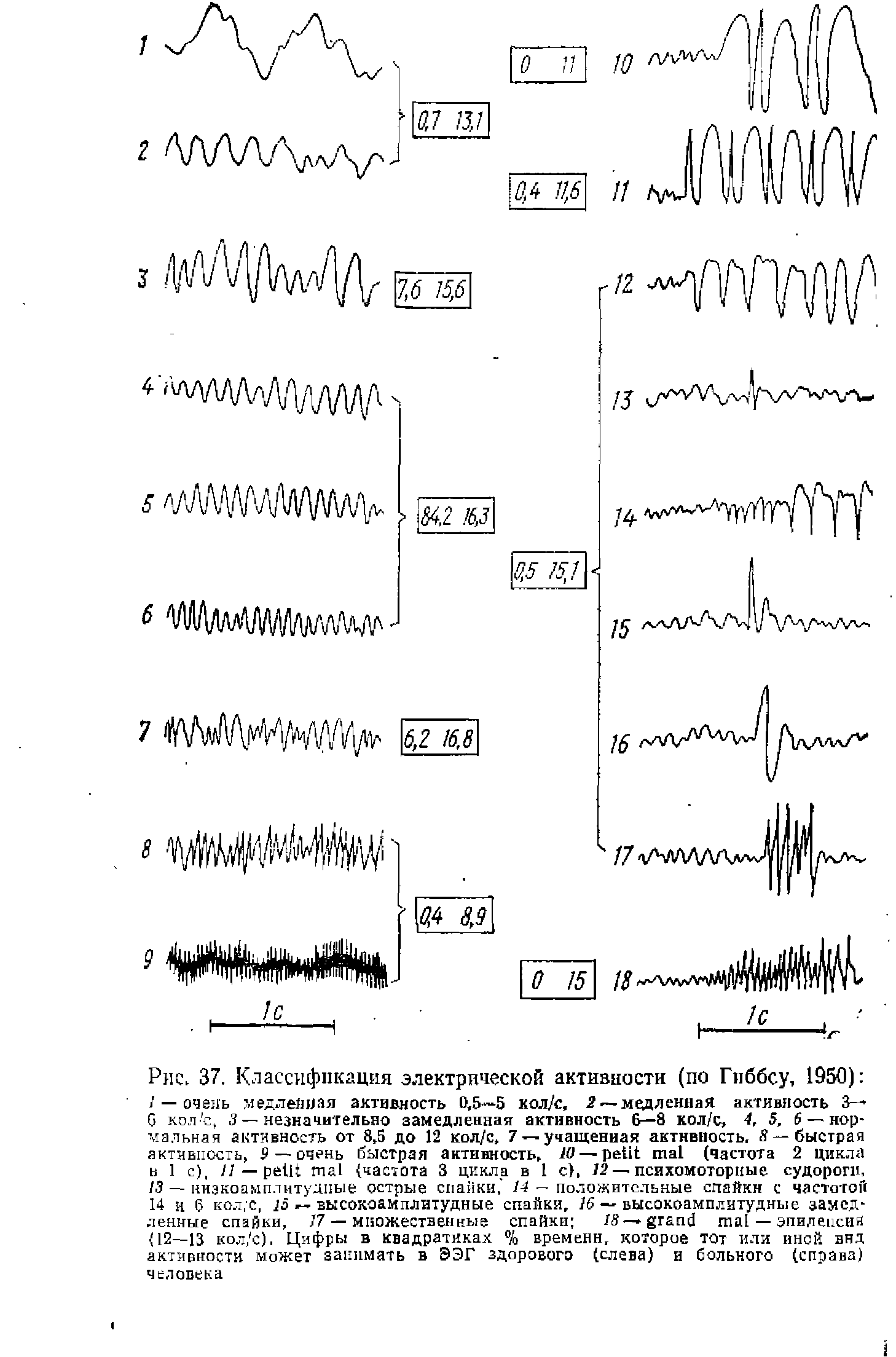 Рис. 37. Классификация электрической активности (по Гиббсу, 1950) / — очень медленная активность 0,5—5 кол/с, 2 —медленная активность 3— G кол е, 3 — незначительно замедленная активность 6—8 кол/е, 4, 5, 6 — нормальная активность от 8,5 до 12 кол/с, 7 —учащенная активность. 8 — быстрая активность, 9 — очень быстрая активность, /0 — (частота 2 цикла в 1 с), // — (частота 3 цикла в 1 с, /2 —психомоторные судороги,...