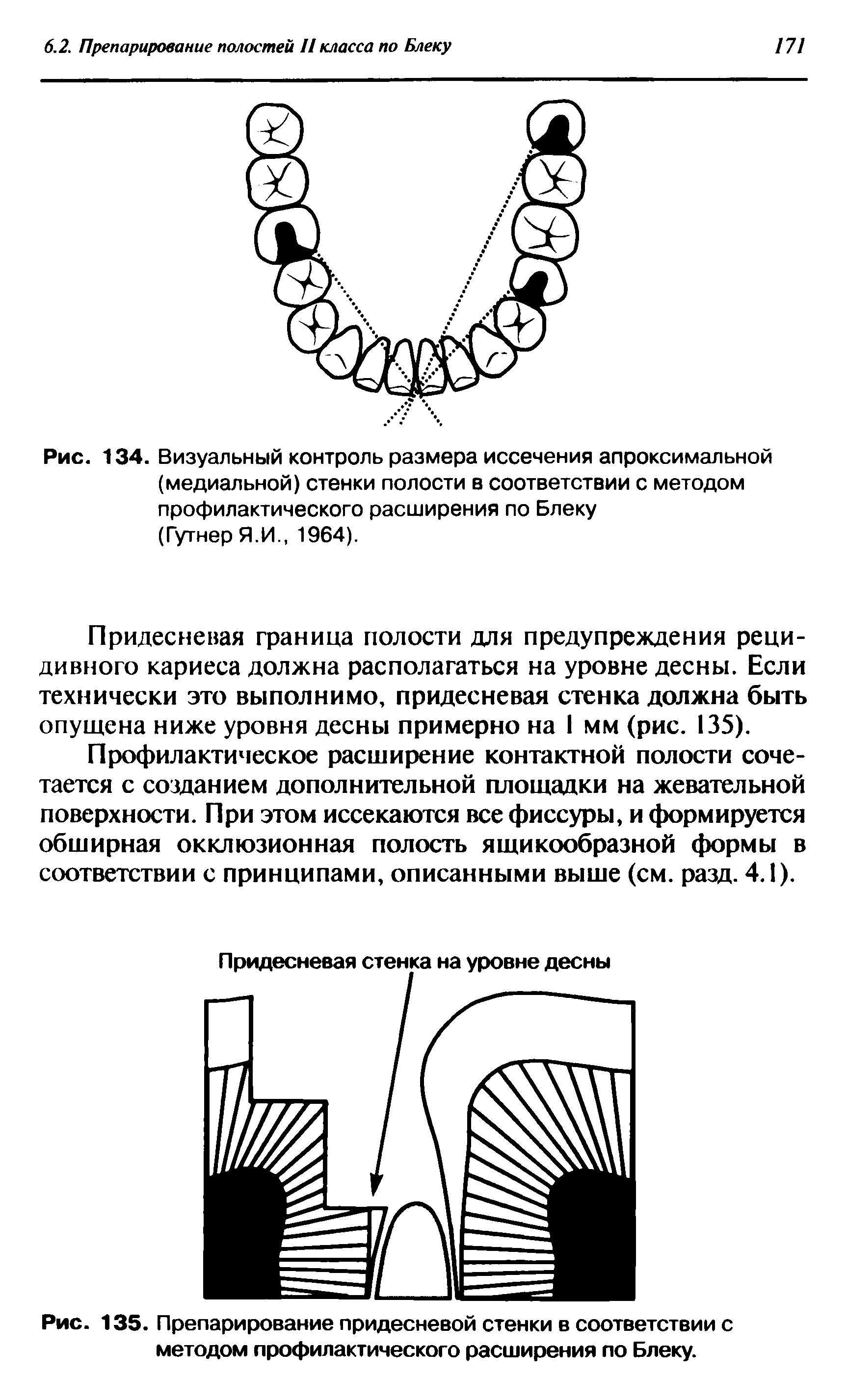 Рис. 135. Препарирование придесневой стенки в соответствии с методом профилактического расширения по Блеку.