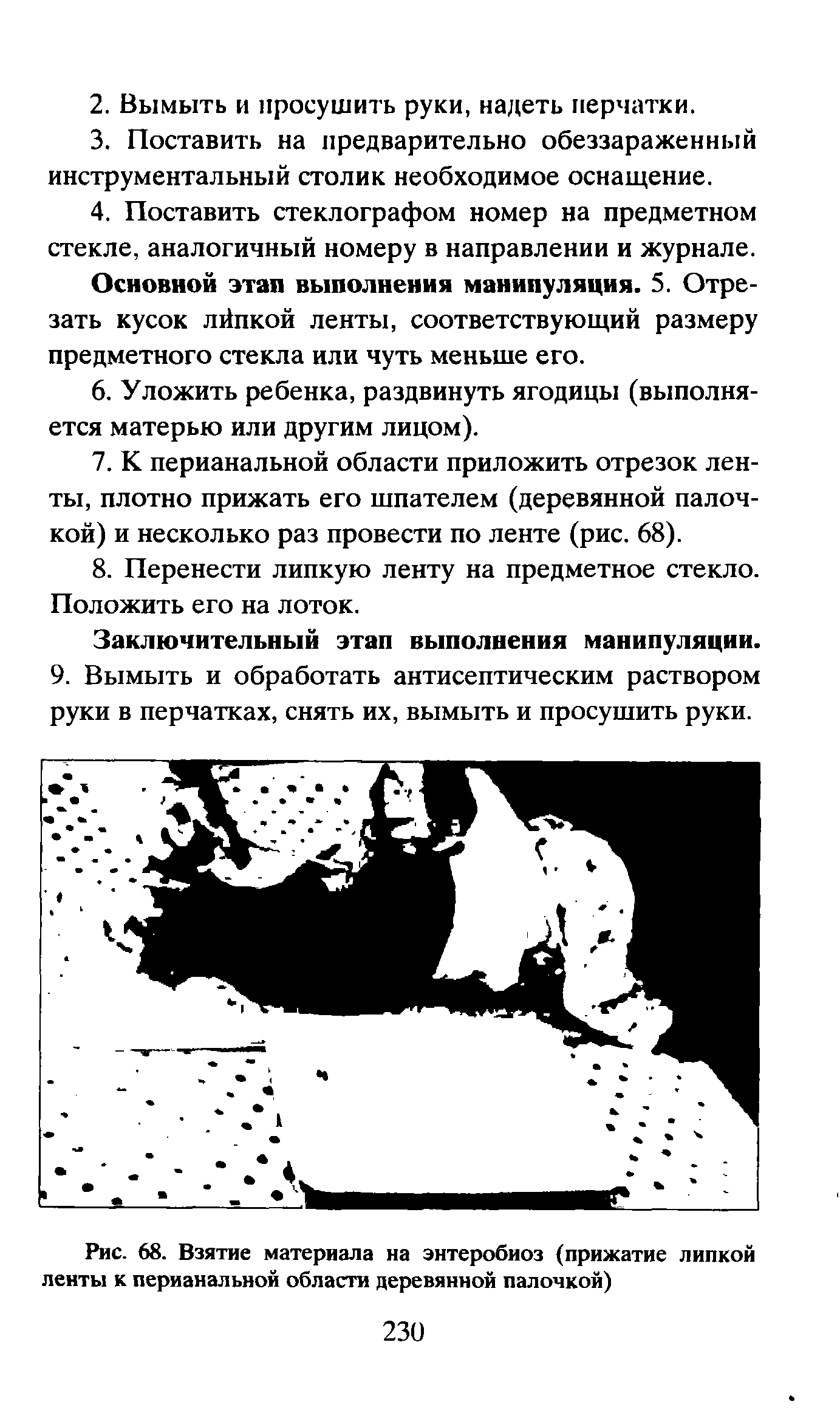 Рис. 68. Взятие материала на энтеробиоз (прижатие липкой ленты к перианальной области деревянной палочкой)...