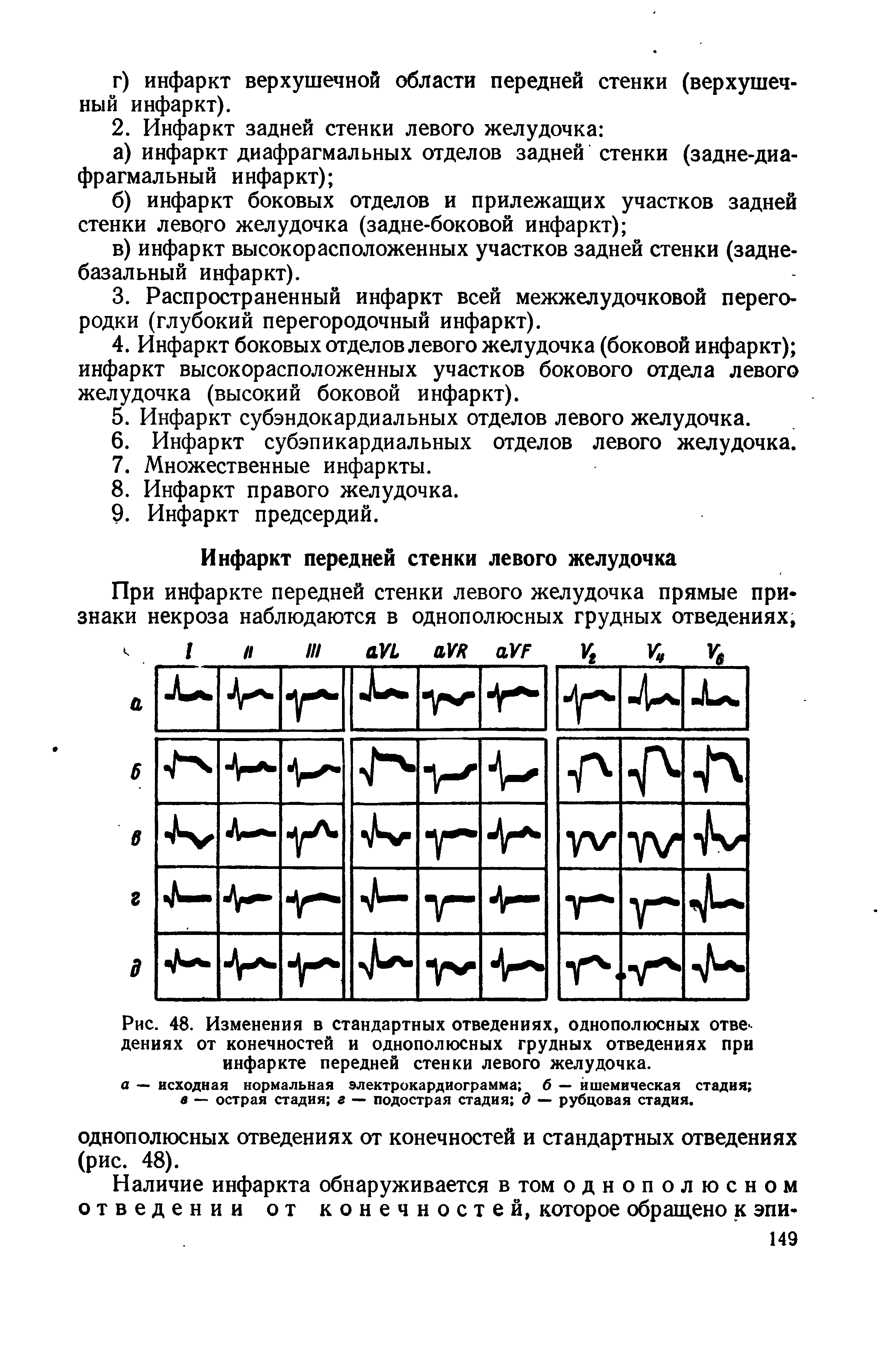 Рис. 48. Изменения в стандартных отведениях, однополюсных отвердениях от конечностей и однополюсных грудных отведениях при инфаркте передней стенки левого желудочка.