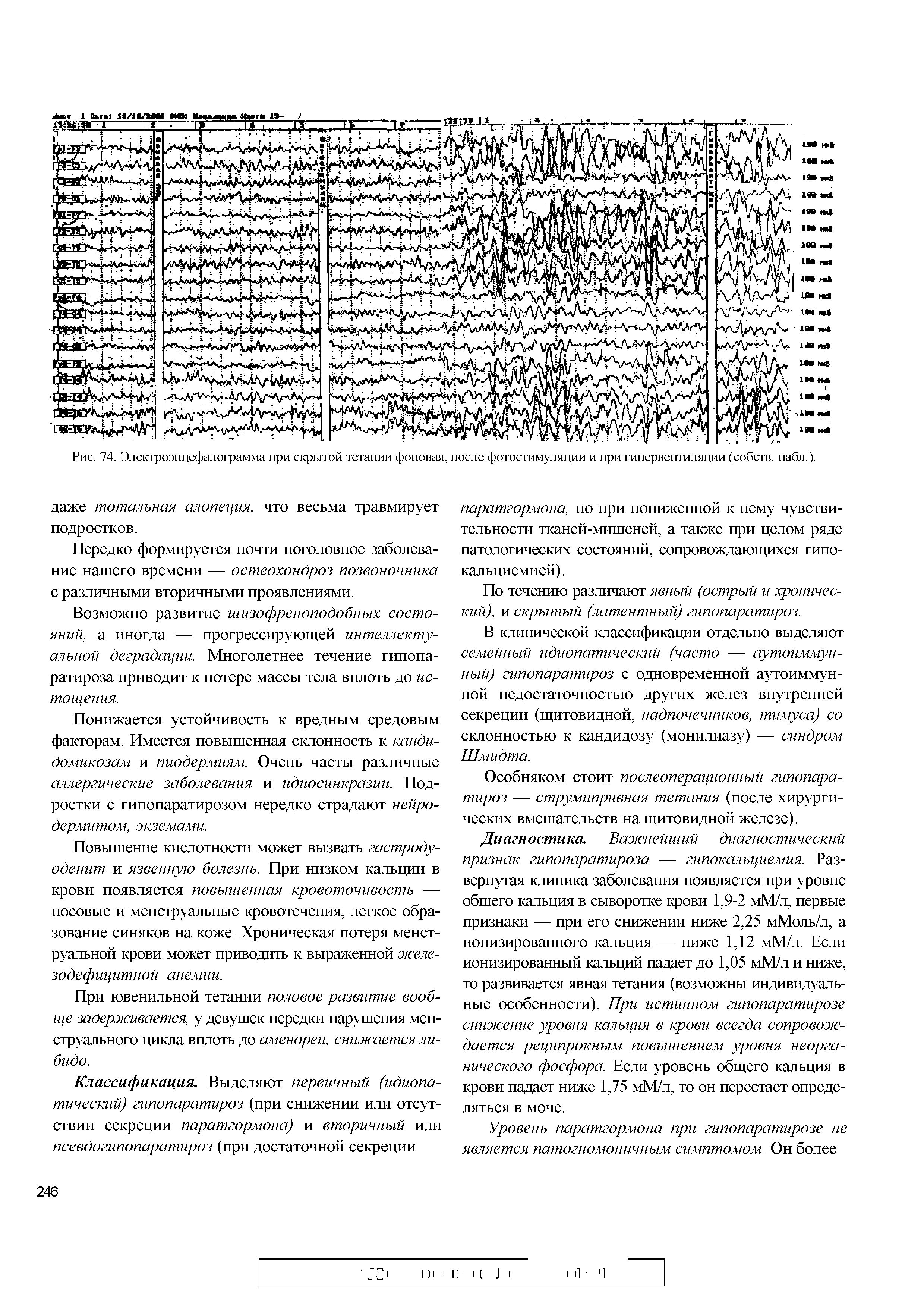 Рис. 74. Электроэнцефалограмма при скрытой тетании фоновая, после фотостимуляции и при гипервентиляции (собств. набл.).