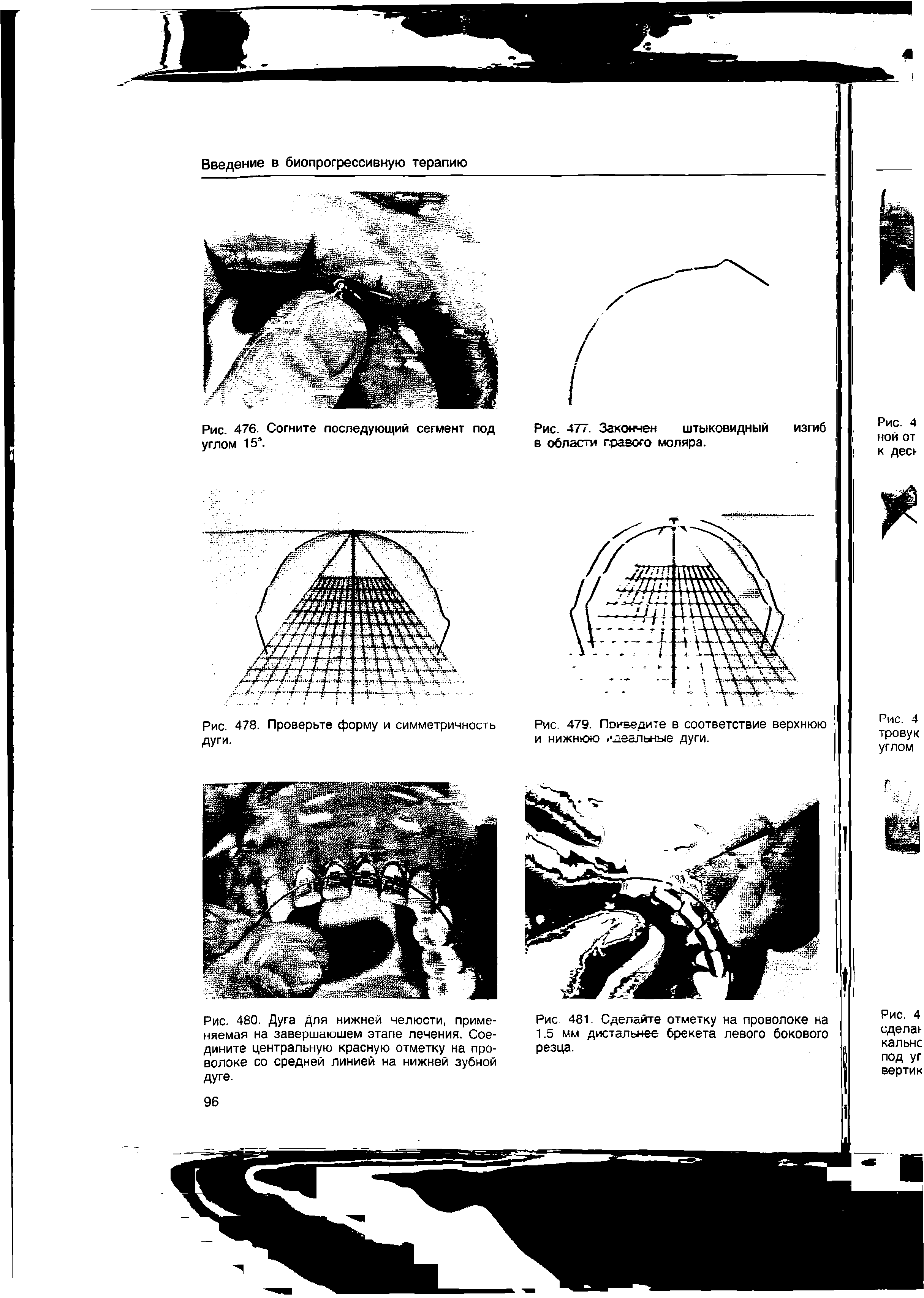 Рис. 480. Дуга для нижней челюсти, применяемая на завершающем этапе лечения. Соедините центральную красную отметку на проволоке со средней линией на нижней зубной...