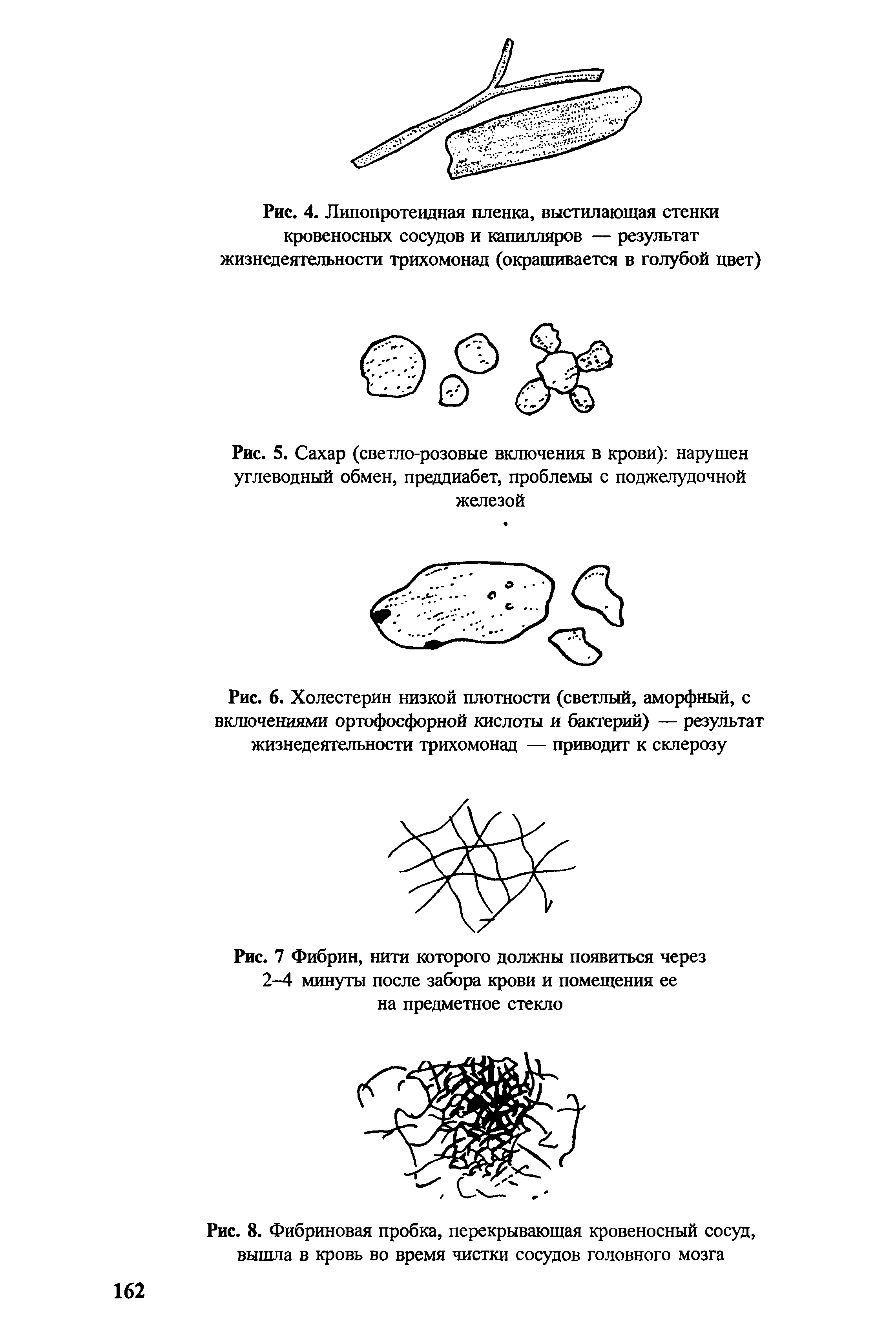 Рис. 6. Холестерин низкой плотности (светлый, аморфный, с включениями ортофосфорной кислоты и бактерий) — результат жизнедеятельности трихомонад — приводит к склерозу...