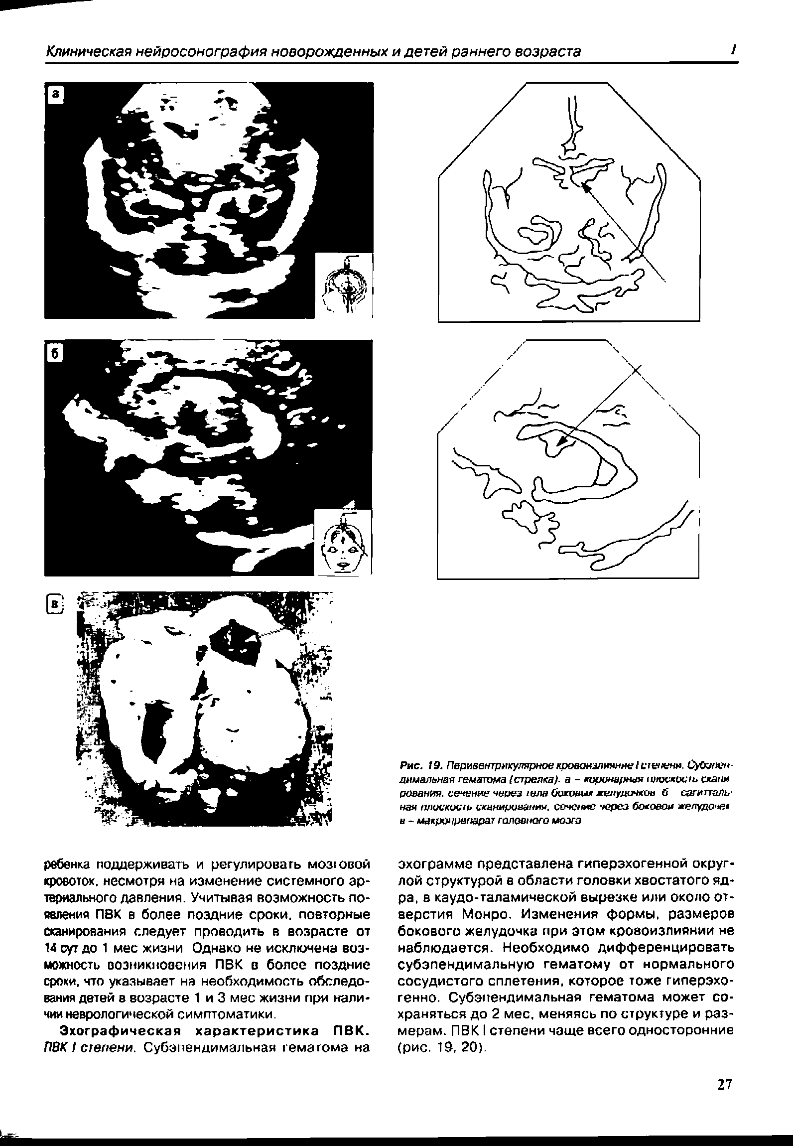 Рис. 19. Пери8ен7рякуляриоекровоизлияняе/сге/ нн. СуОмен днмальная гематома (стрелка), а - кирцнарная ипхжосчь схагш иования. сечение через ела Оокоамх келудичкоо б сагиггапь-нам плоскость сханириеаним. содоме через бсмдоон желудоче а - мацючрепарат головного мозга...