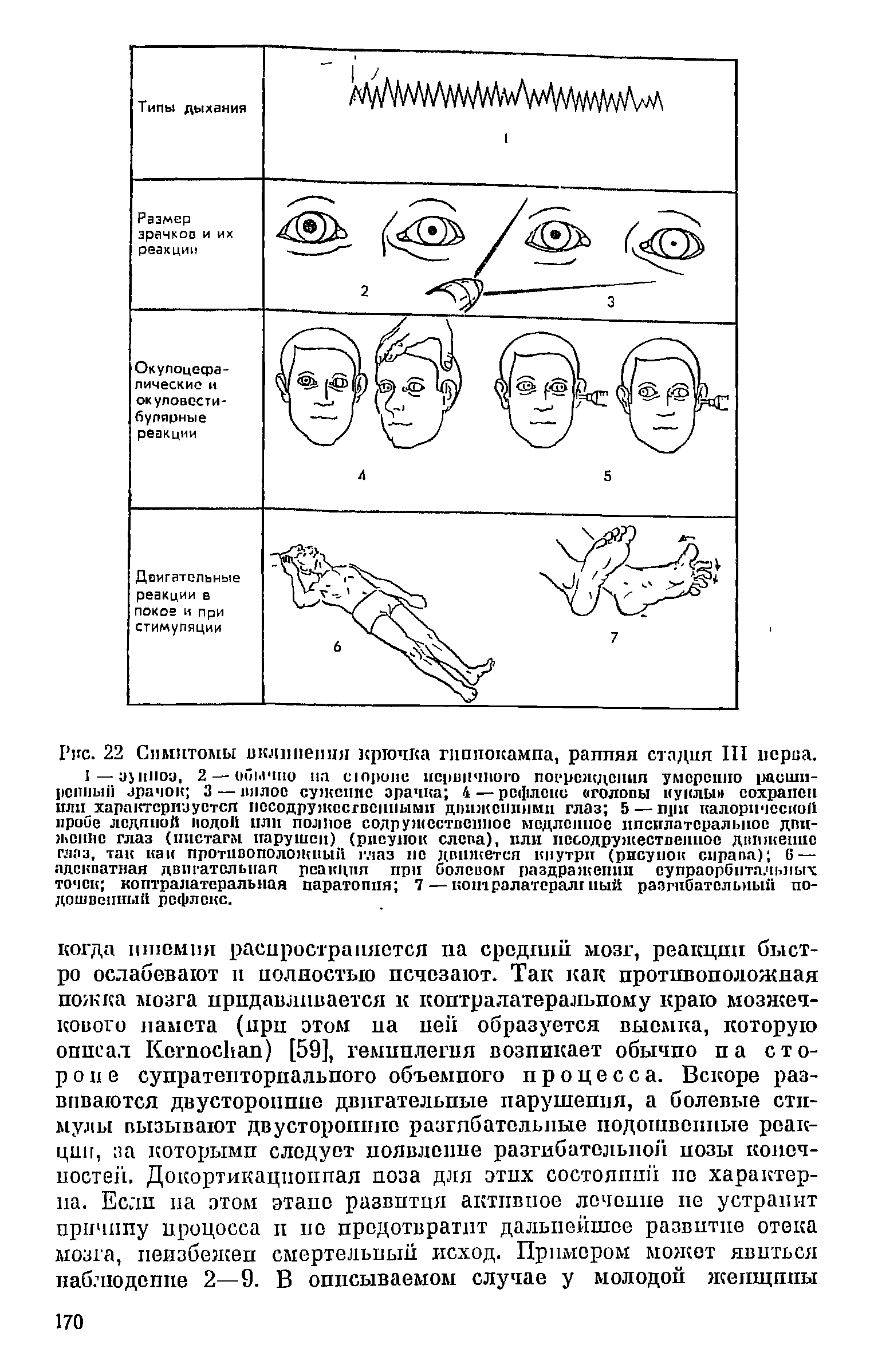 Рис. 22 Симптомы вклинения крючка гиппокампа, раппяя стадия III верна.