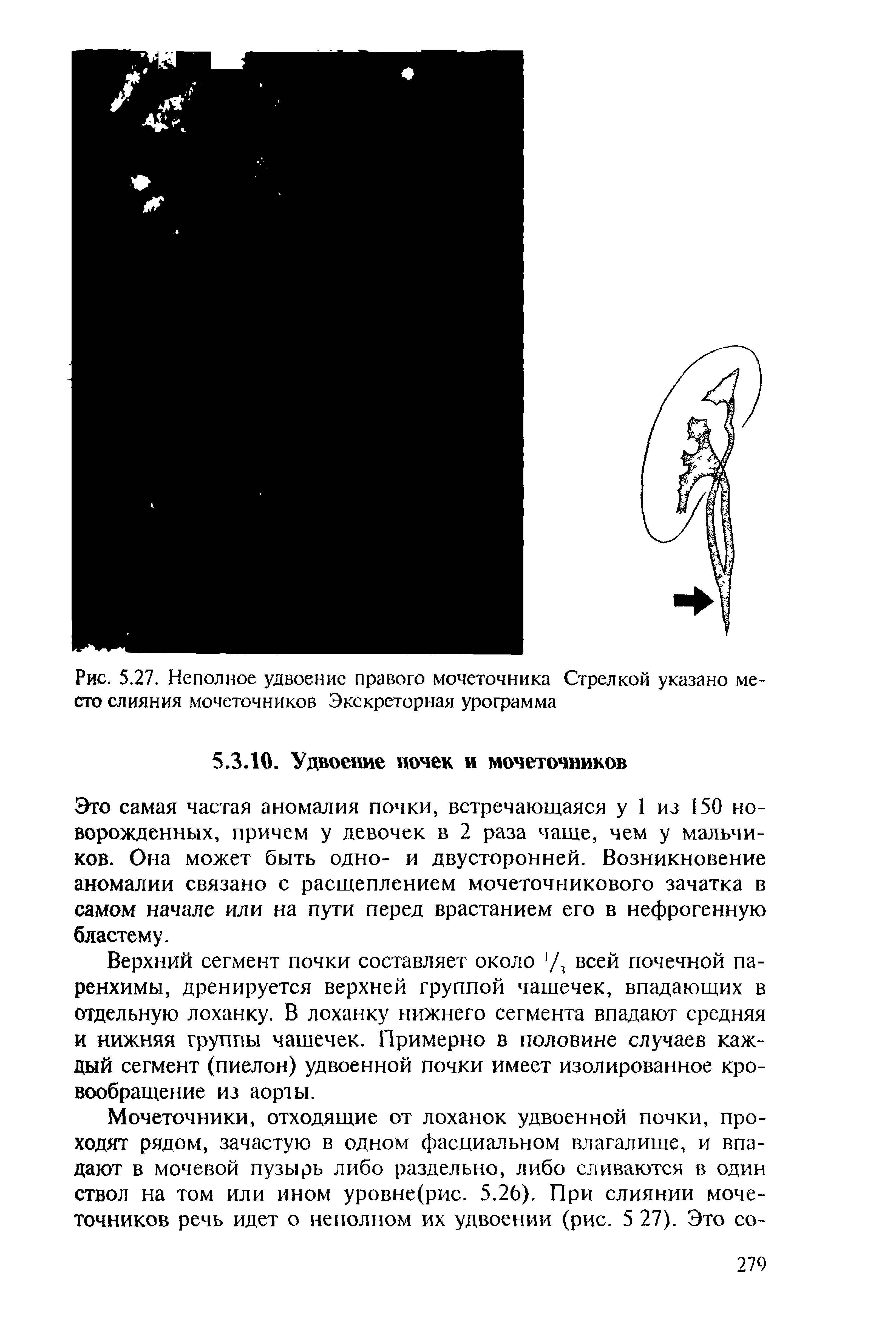 Рис. 5.27. Неполное удвоение правого мочеточника Стрелкой указано место слияния мочеточников Экскреторная урограмма...