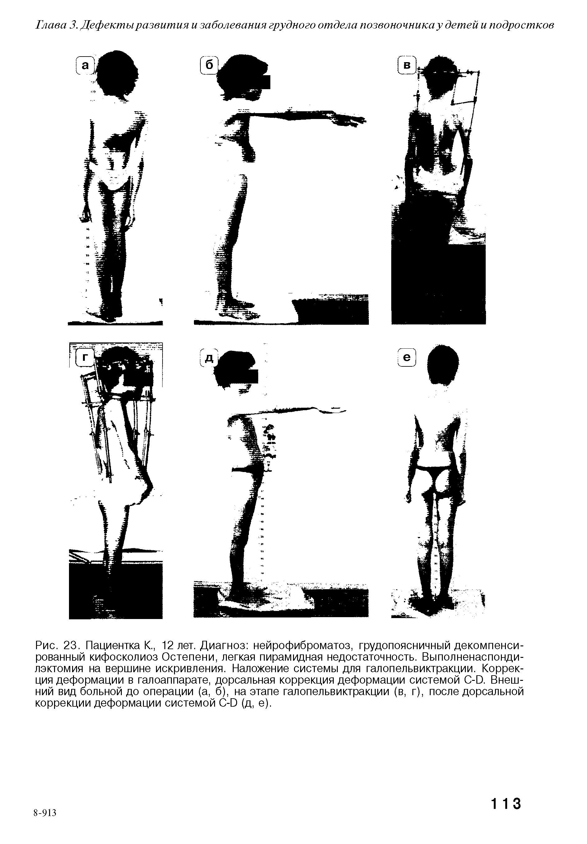 Рис. 23. Пациентка К., 12 лет. Диагноз нейрофиброматоз, грудопоясничный декомпенсированный кифосколиоз Остепени, легкая пирамидная недостаточность. Выполненаспонди-лэктомия на вершине искривления. Наложение системы для галопельвиктракции. Коррекция деформации в галоаппарате, дорсальная коррекция деформации системой С-Ю. Внешний вид больной до операции (а, б), на этапе галопельвиктракции (в, г), после дорсальной коррекции деформации системой С-Ю (д, е).