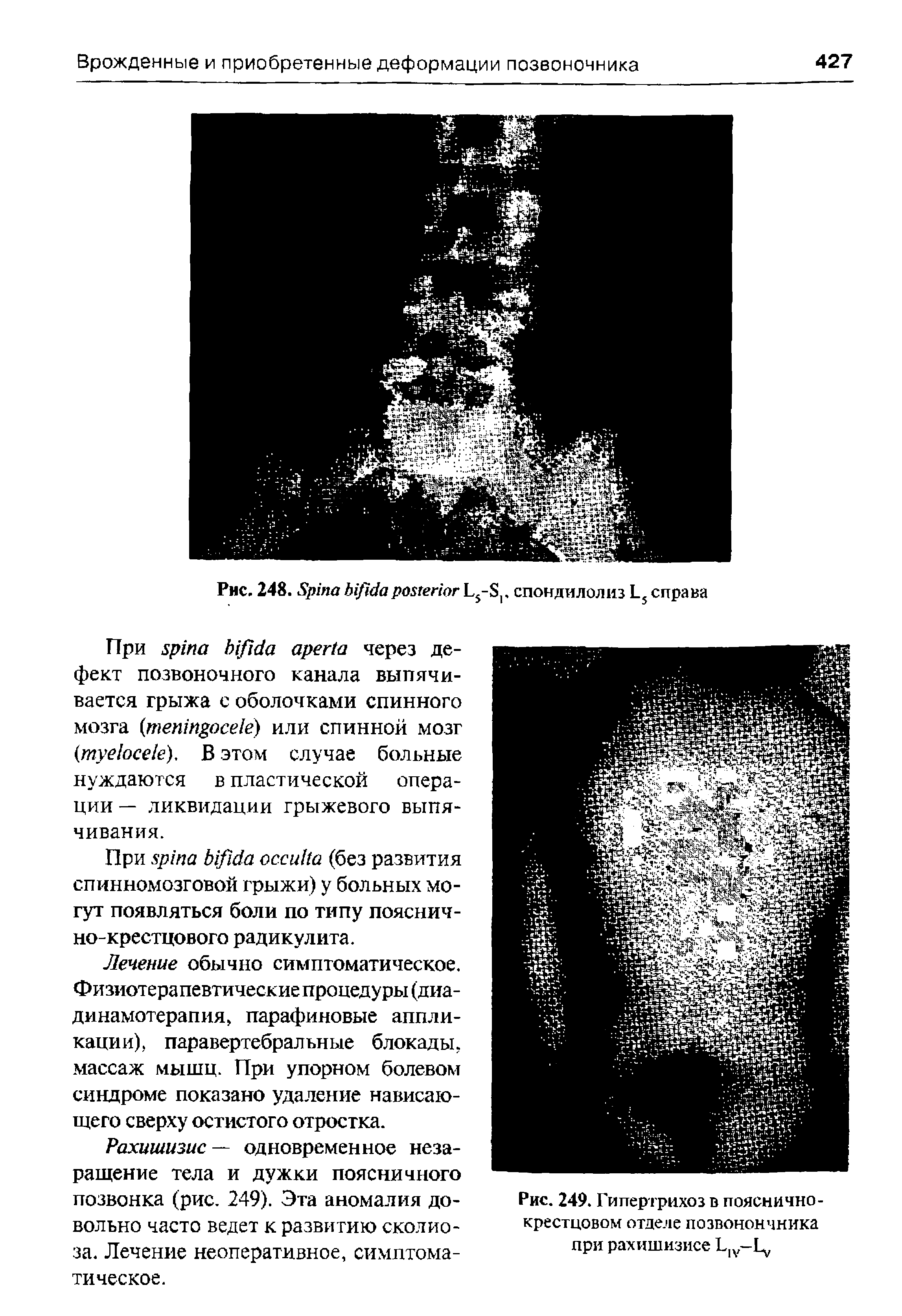 Рис. 249. Гипертрихоз в пояснично-крестцовом отделе позвонончника при рахишизисе Ь1У-1 ...