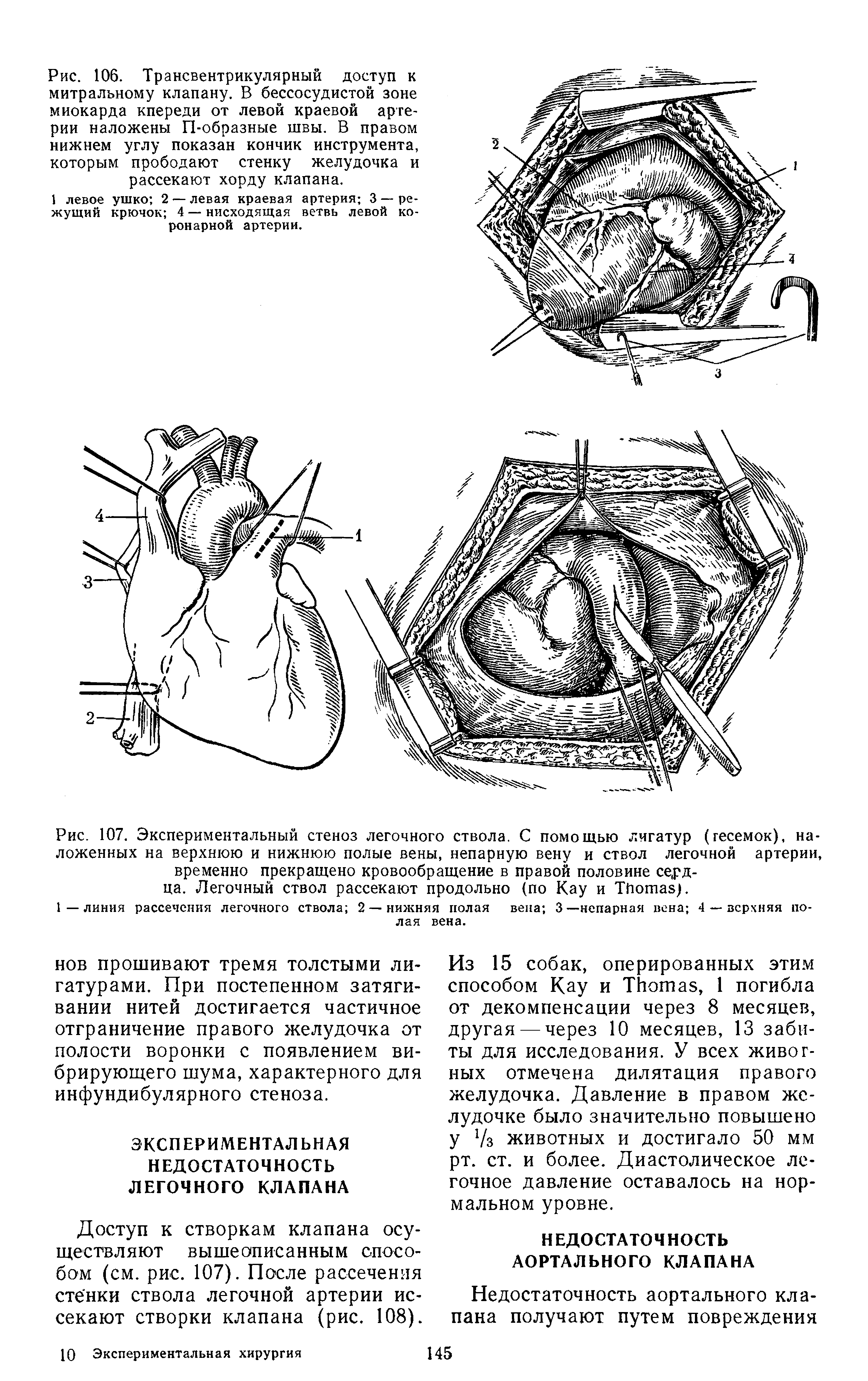 Рис. 107. Экспериментальный стеноз легочного ствола. С помощью лигатур (гесемок), наложенных на верхнюю и нижнюю полые вены, непарную вену и ствол легочной артерии, временно прекращено кровообращение в правой половине сердца. Легочный ствол рассекают продольно (по Кау и T ).