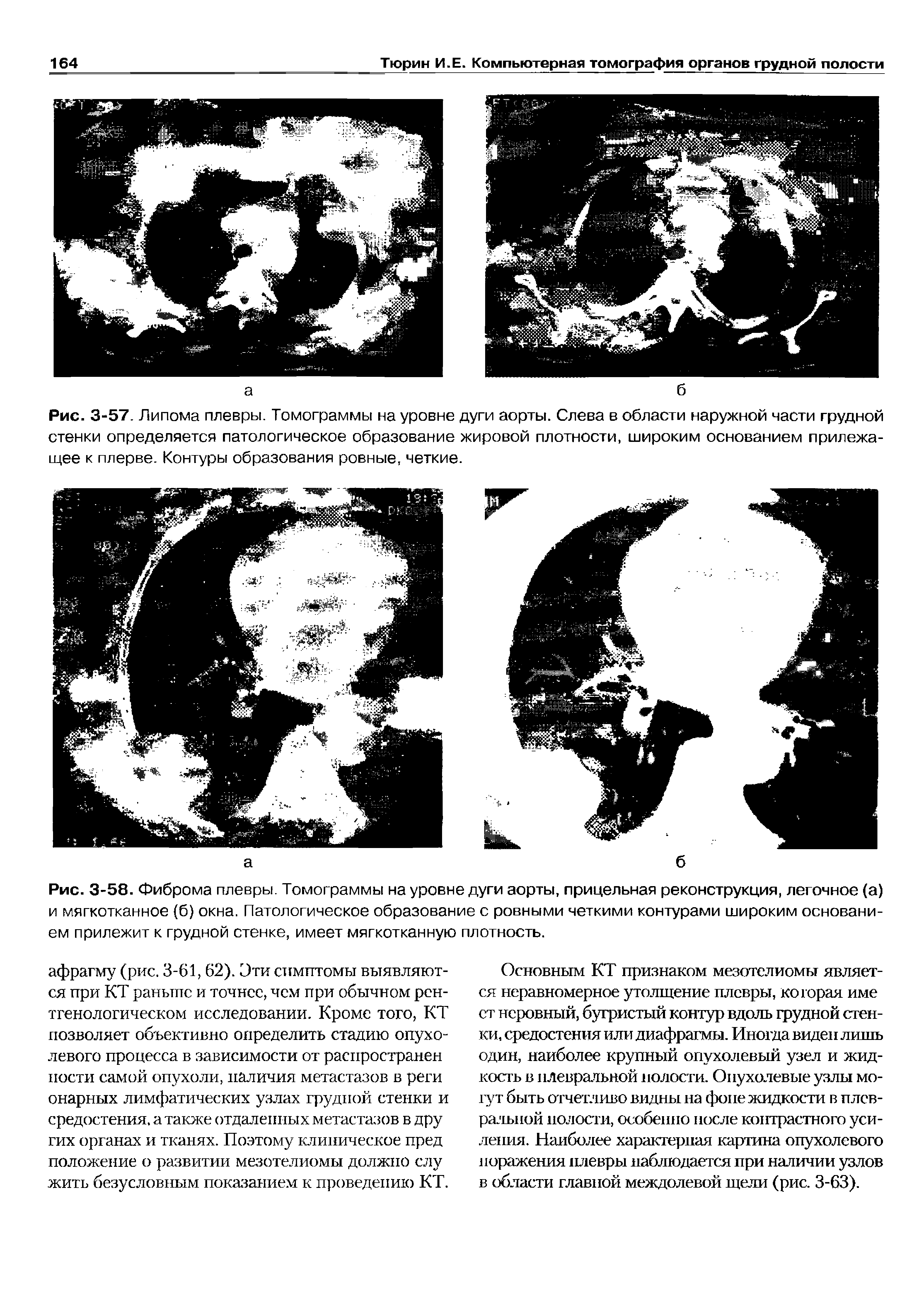 Рис. 3-58. Фиброма плевры. Томограммы на уровне дуги аорты, прицельная реконструкция, легочное (а) и мягкотканное (б) окна. Патологическое образование с ровными четкими контурами широким основанием прилежит к грудной стенке, имеет мягкотканную плотность.