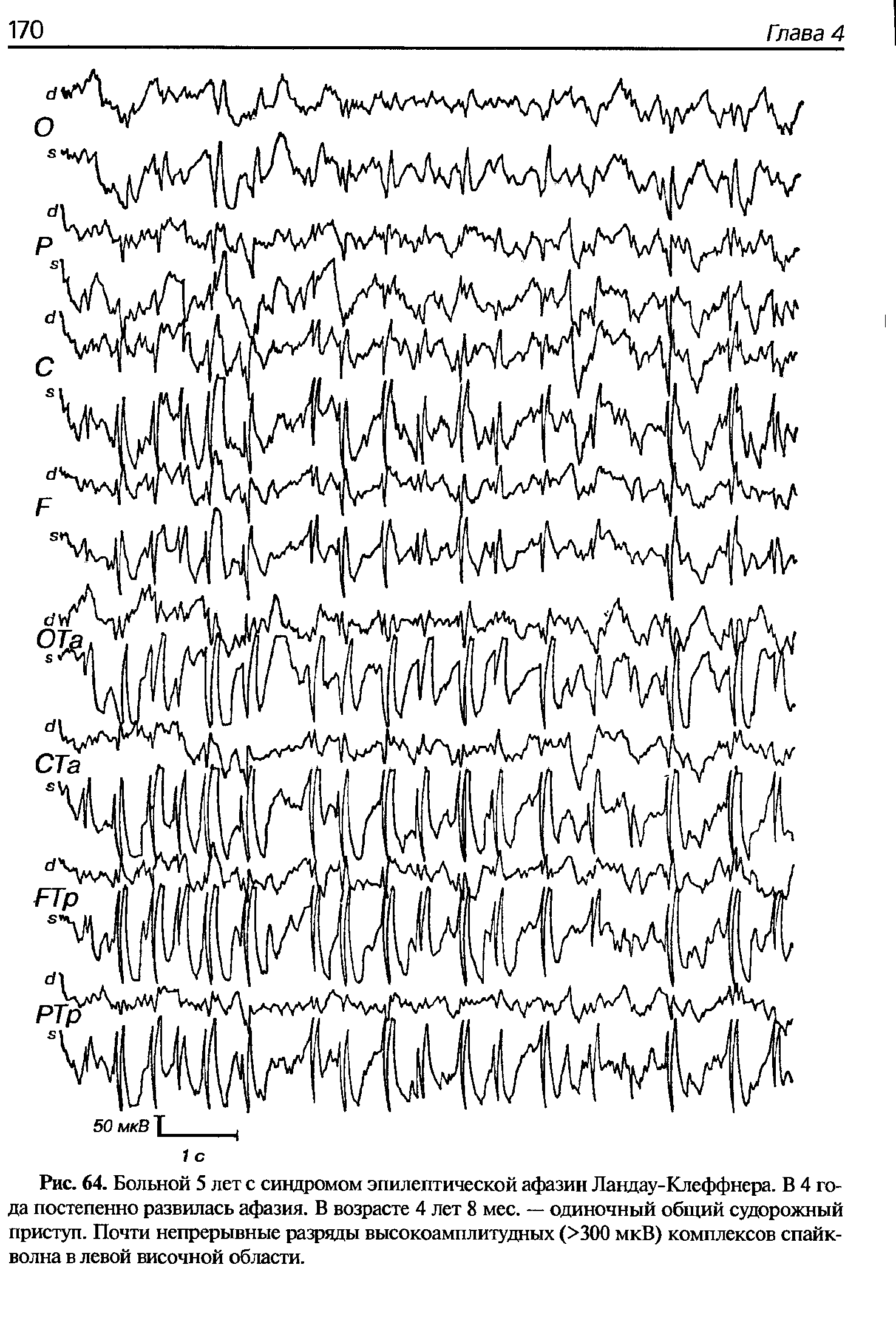 Рис. 64. Больной 5 лет с синдромом эпилептической афазии Ландау-Клеффнера. В 4 года постепенно развилась афазия. В возрасте 4 лет 8 мес. — одиночный общий судорожный приступ. Почти непрерывные разряды высокоамплитудных (>300 мкВ) комплексов спайк-волна в левой височной области.