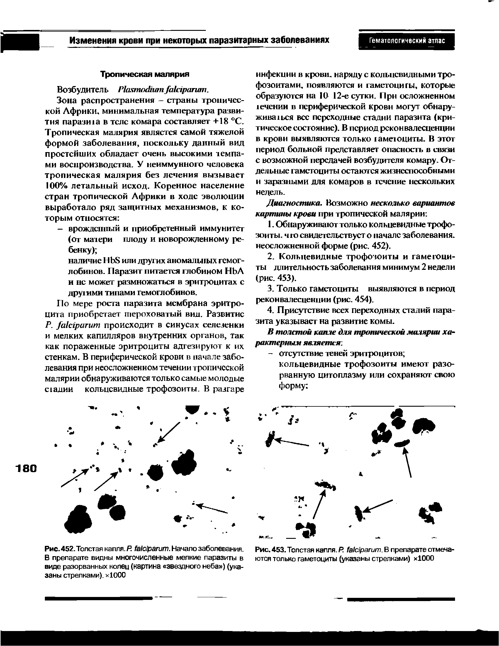 Рис.452. Толстая капля. Р. . Начало заболевания. В препарате видны многочисленные мелкие паразиты в виде разорванных колеи (картина звездного неба ) (указаны стрелками). >1000...