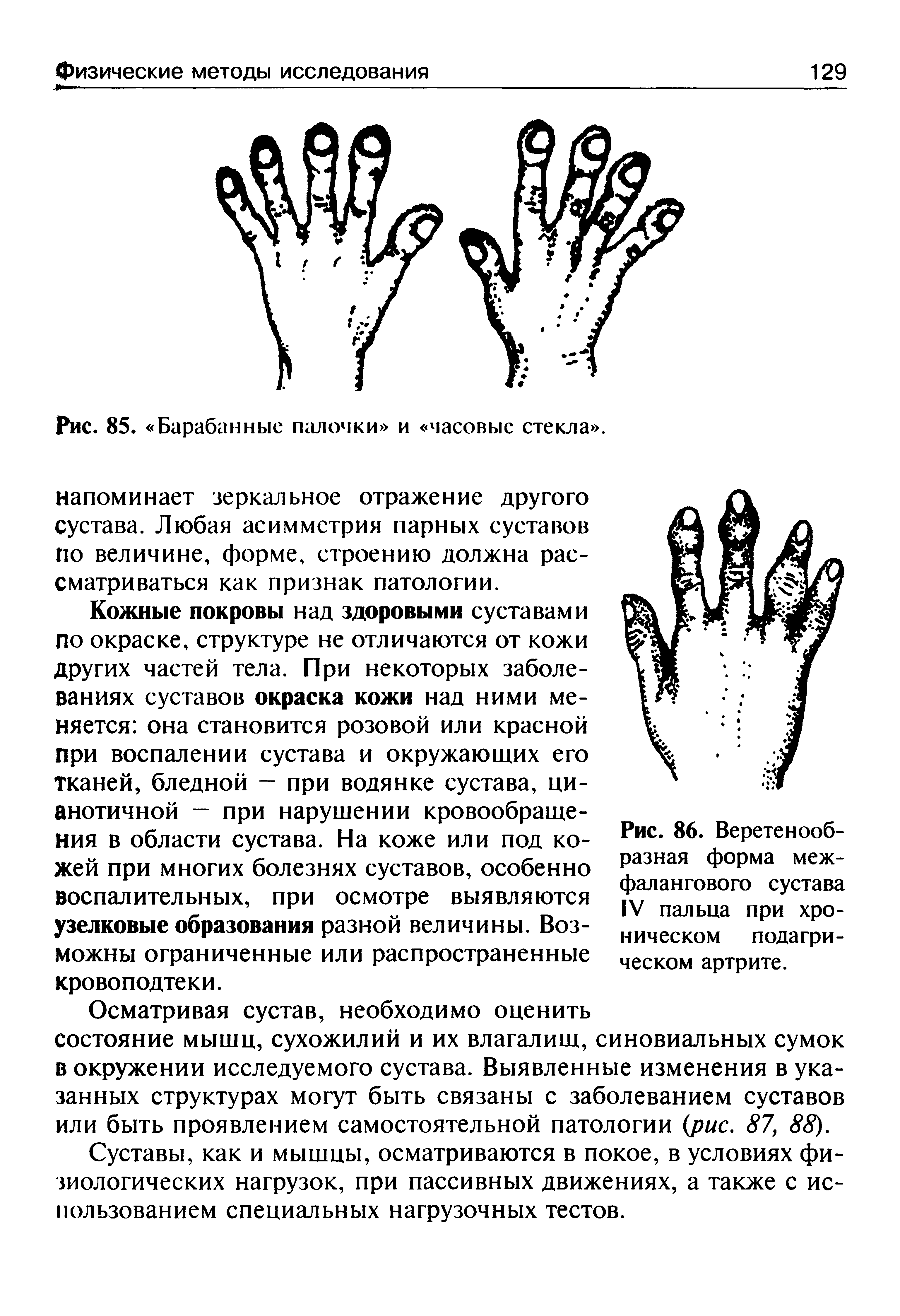 Рис. 86. Веретенообразная форма межфалангового сустава IV пальца при хроническом подагрическом артрите.