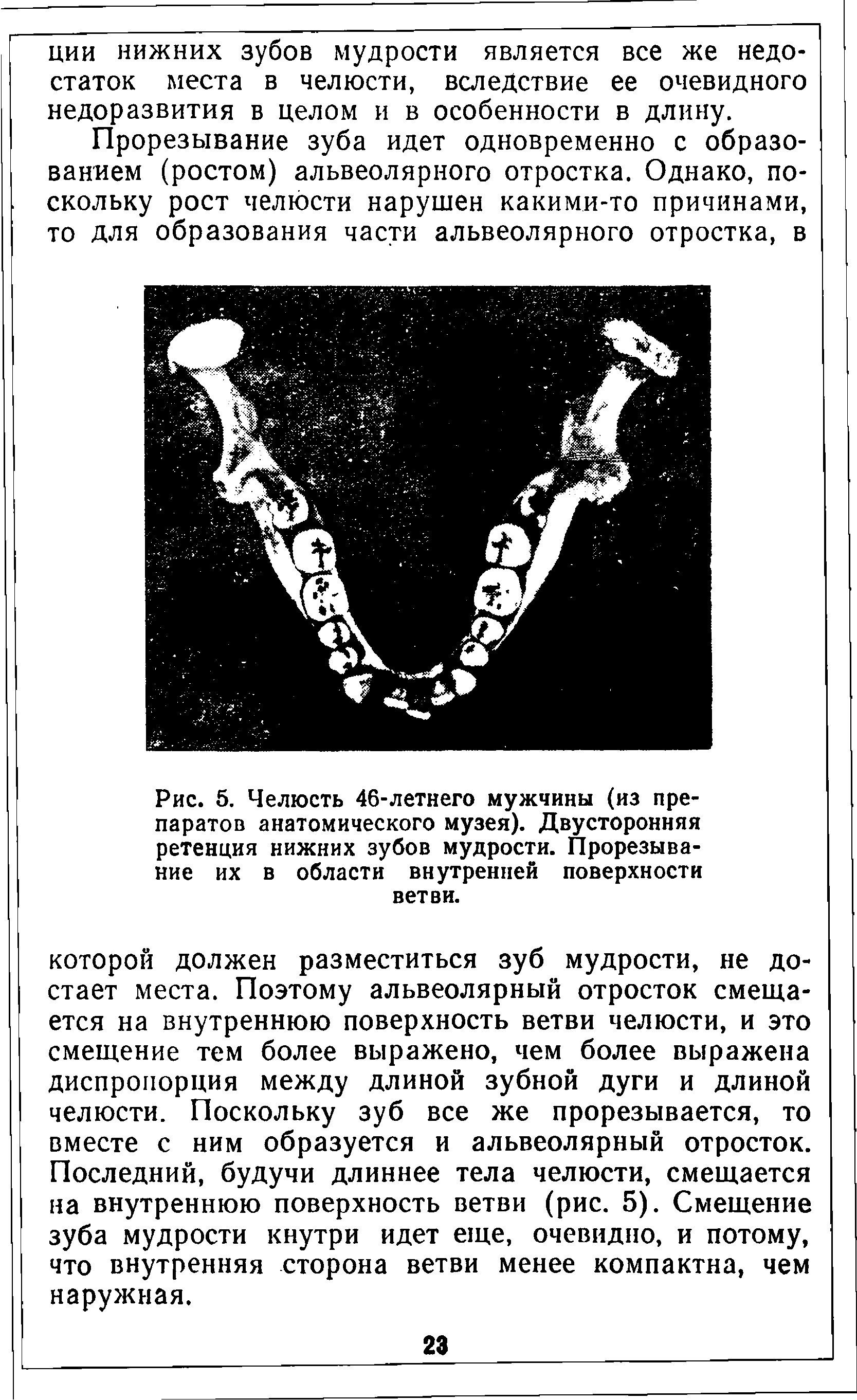 Рис. 5. Челюсть 46-летнего мужчины (из препаратов анатомического музея). Двусторонняя ретенция нижних зубов мудрости. Прорезывание их в области внутренней поверхности ветви.