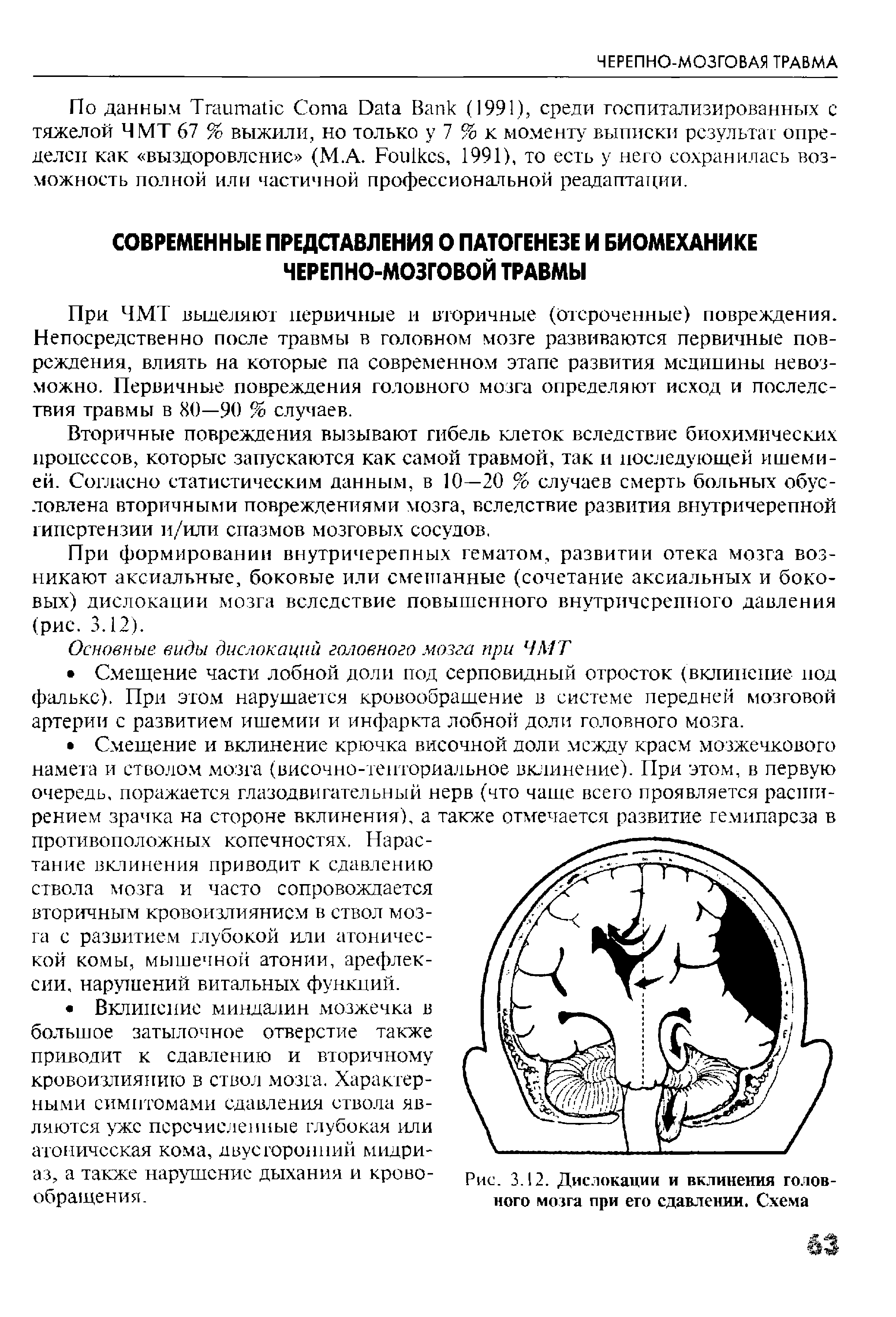 Рис. 3.12. Дислокации и вклинения головного мозга при его сдавлении. Схема...