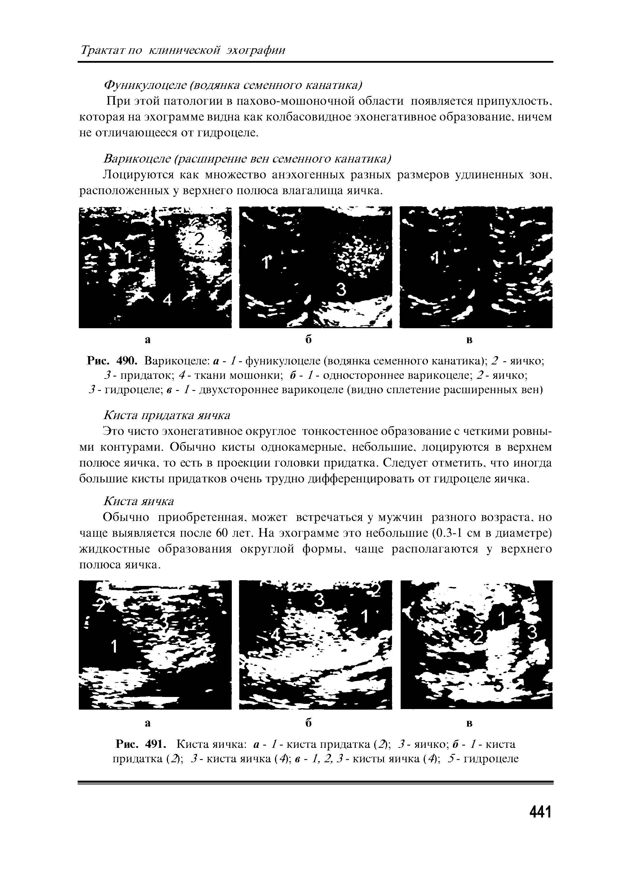 Рис. 490. Варикоцеле а - 1 - фуникулоцеле (водянка семенного канатика) 2 - яичко 3- придаток 4- ткани мошонки б - 1 - одностороннее варикоцеле 2- яичко ...