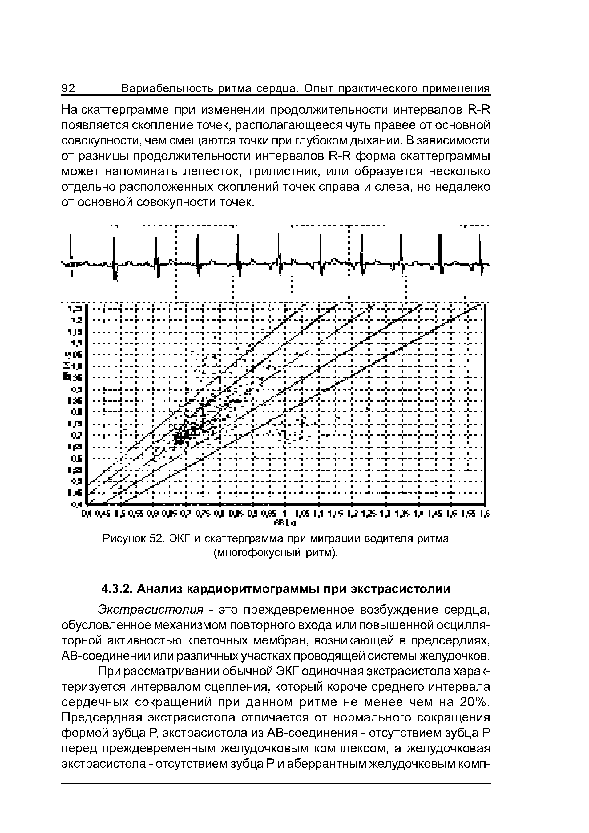 Рисунок 52. ЭКГ и скаттерграмма при миграции водителя ритма (многофокусный ритм).