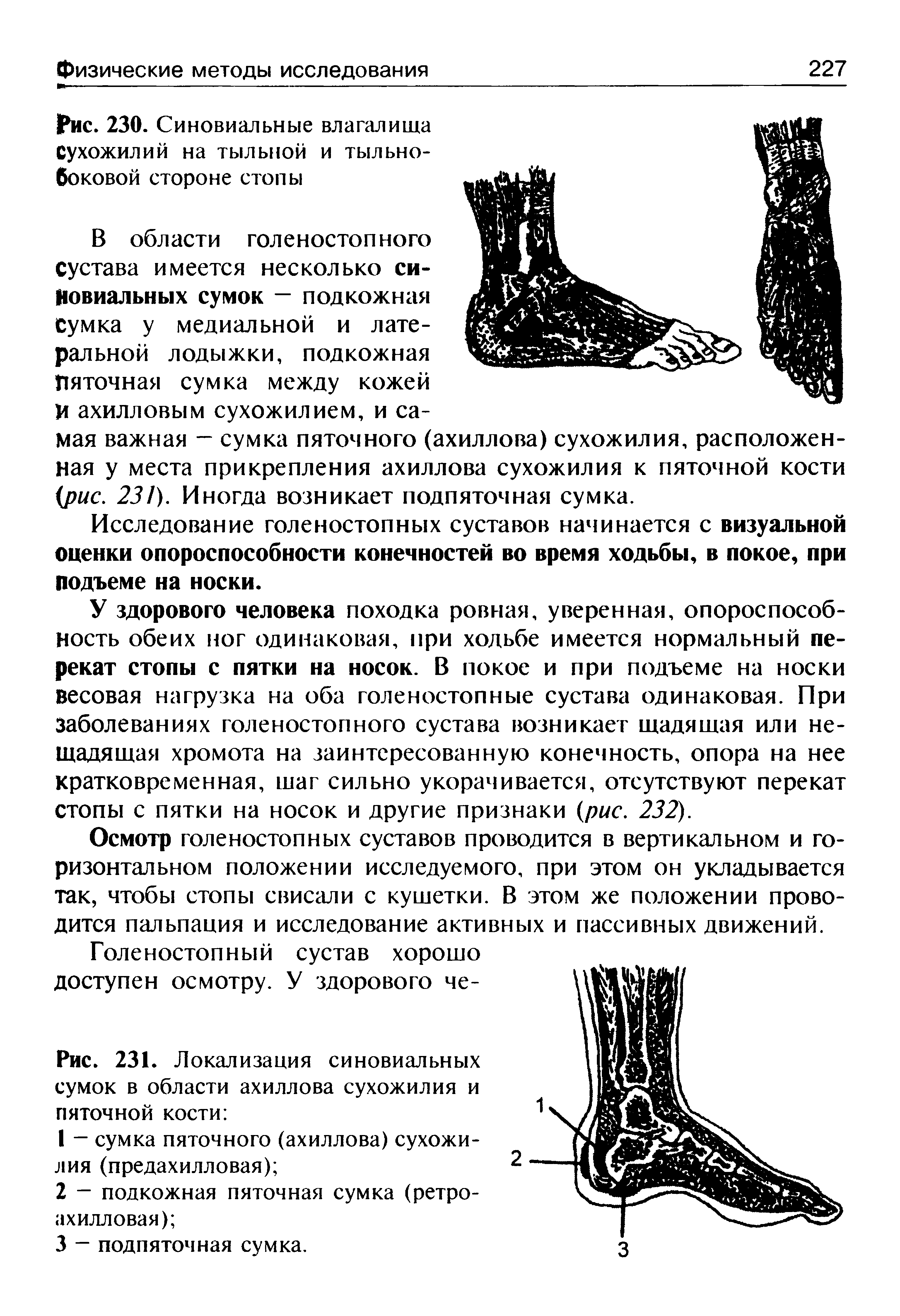 Рис. 231. Локализация синовиальных сумок в области ахиллова сухожилия и пяточной кости ...