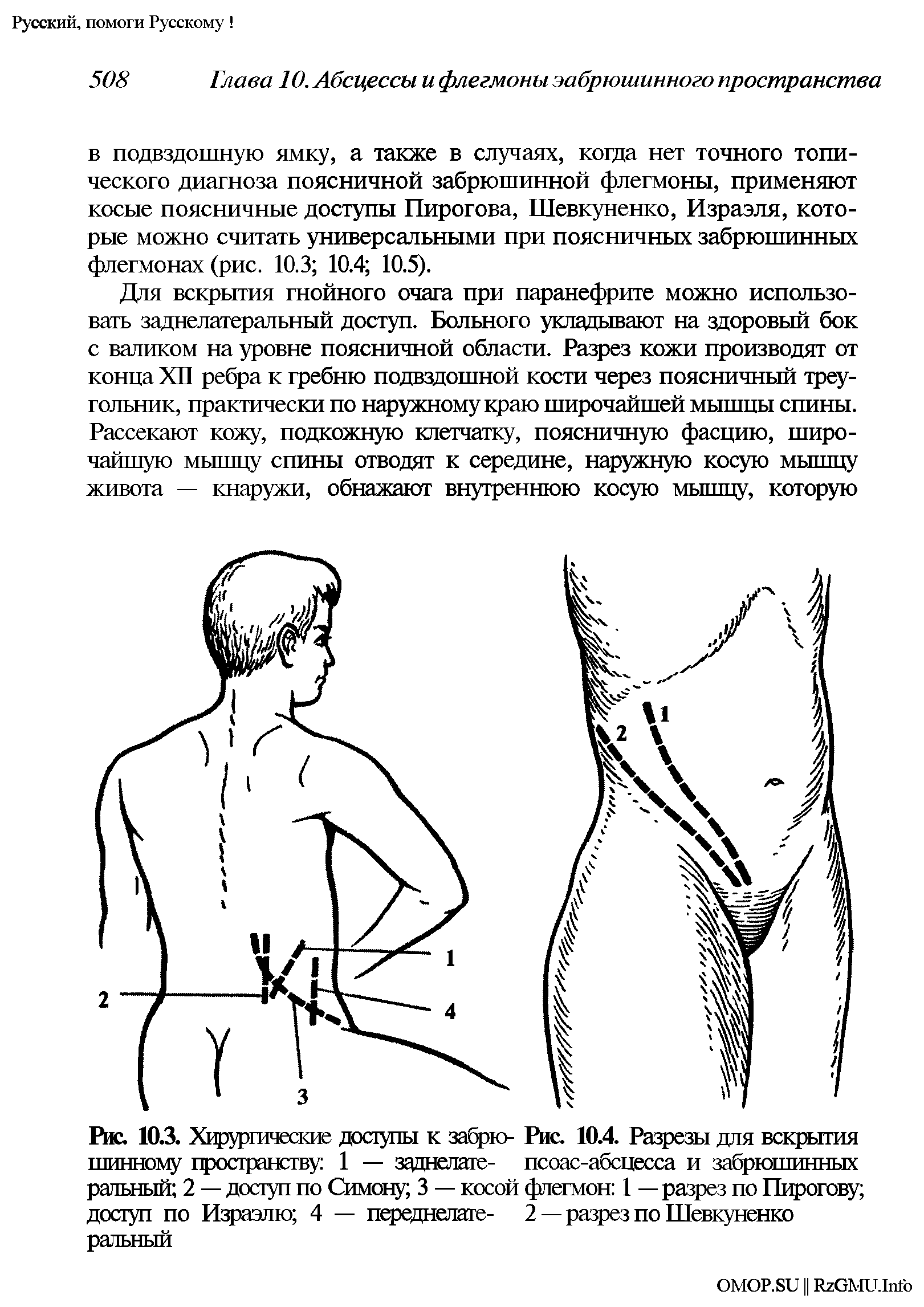 Рис. 10.3. Хирургаческие доступы к забрю- Рис. 10.4. Разрезы для вскрытия шинному пространству 1 — заднелаге- псоас-абспесса и забрюшинных ральный 2 — доступ по Симону 3 — косой флегмон 1 — разрез по Пирогову доступ по Израэлю 4 — переднепате- 2 — разрез по Шевкуненко ральный...