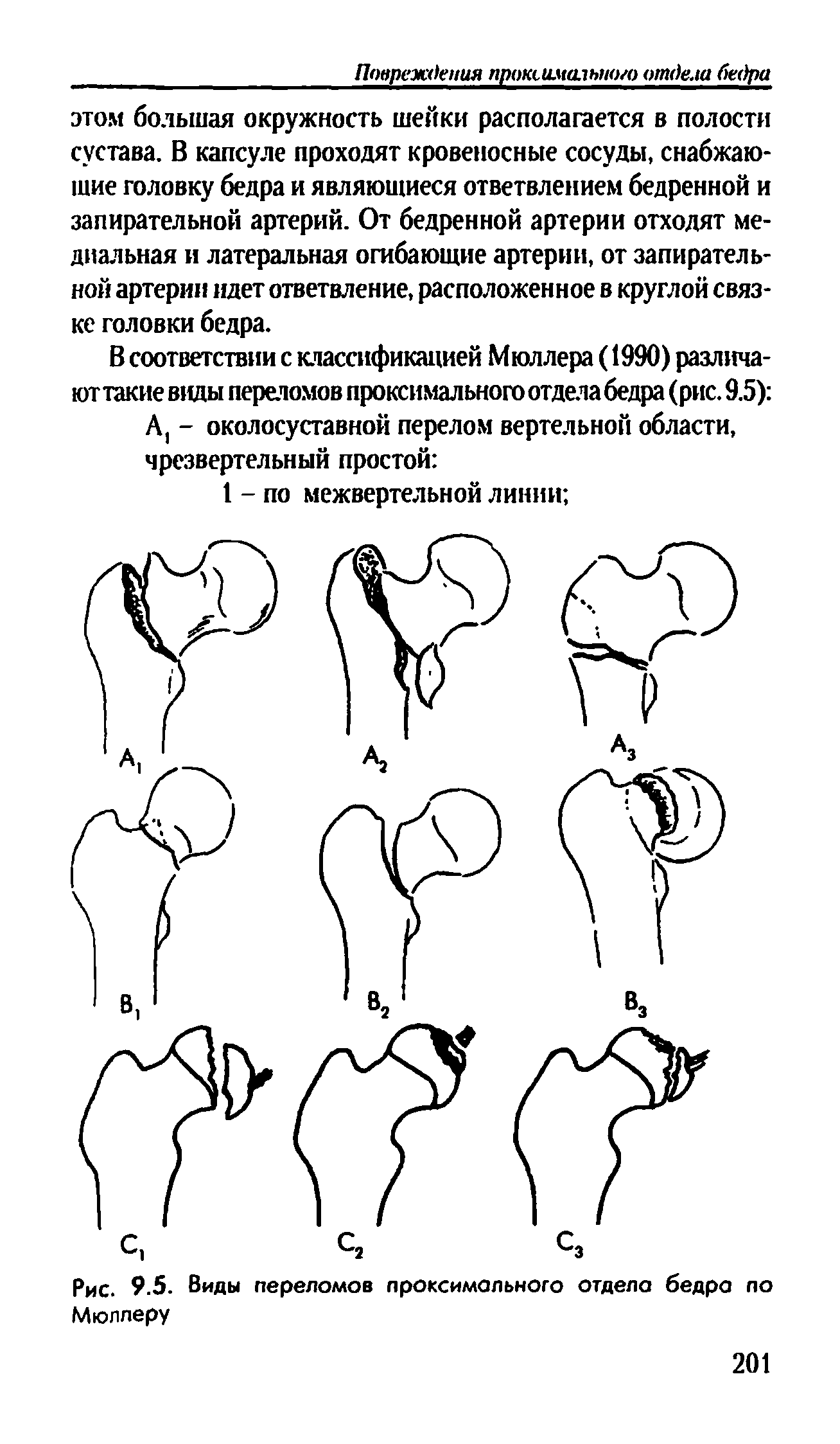 Рис. 9.5. Виды переломов проксимального отдела бедра по Мюллеру...