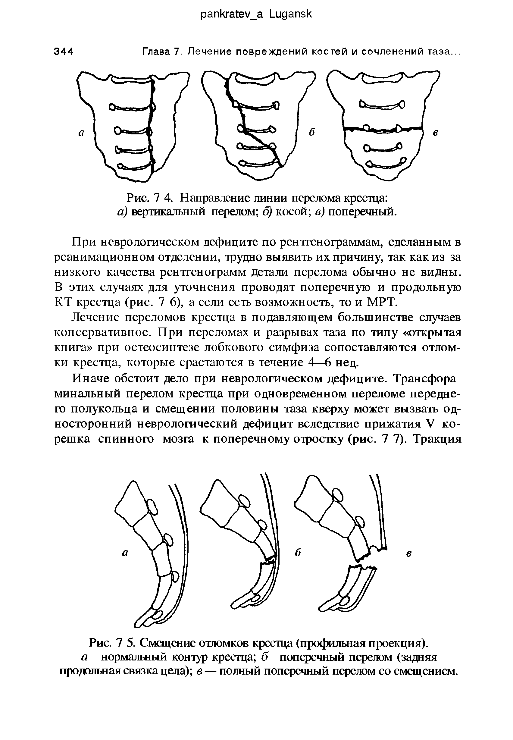 Рис. 7 5. Смещение отломков крестца (профильная проекция). а нормальный контур крестца б поперечный перелом (задняя продольная связка цела) в — полный поперечный перелом со смещением.