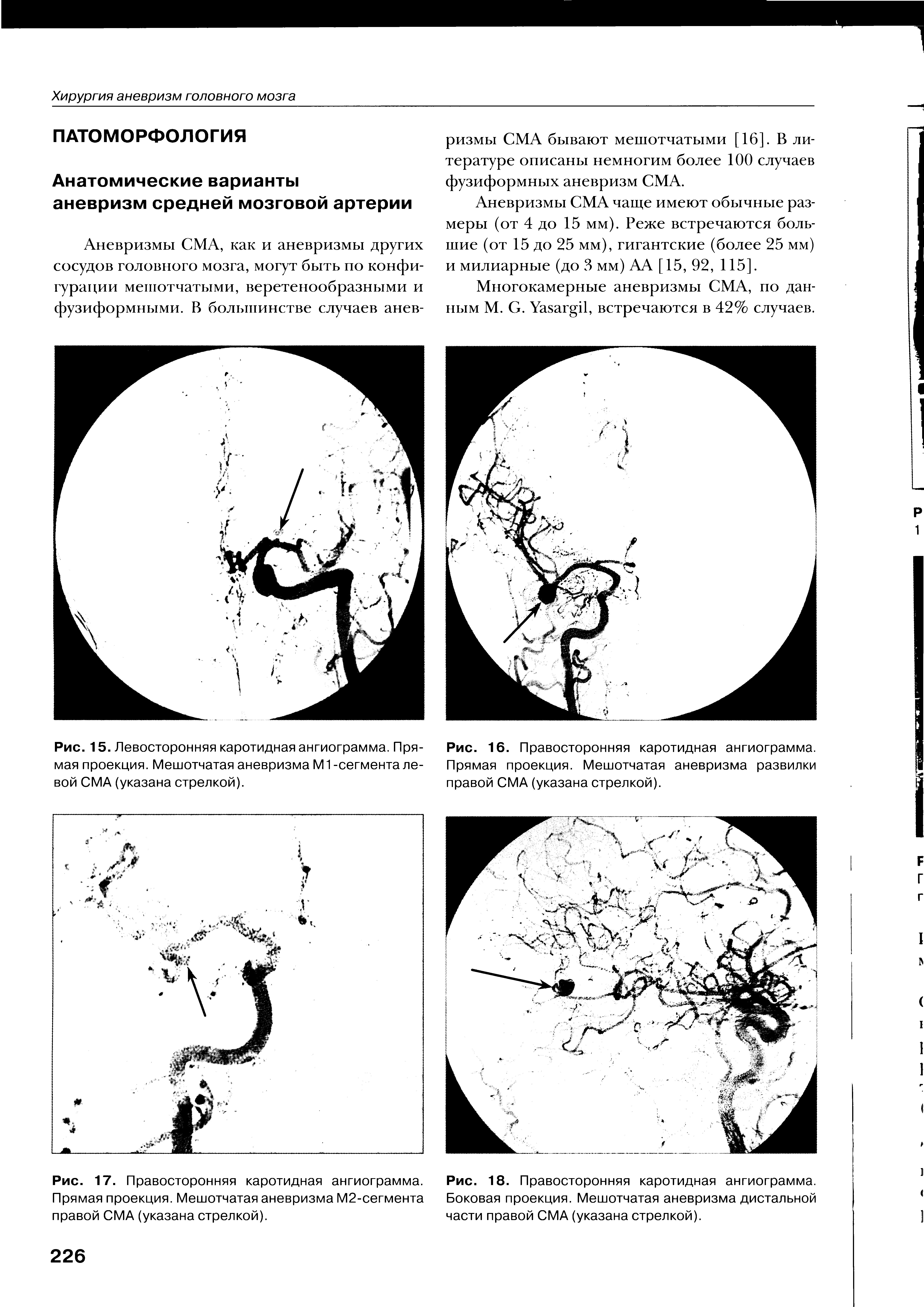 Рис. 15. Левосторонняя каротидная ангиограмма. Прямая проекция. Мешотчатая аневризма М1 -сегмента левой СМА (указана стрелкой).