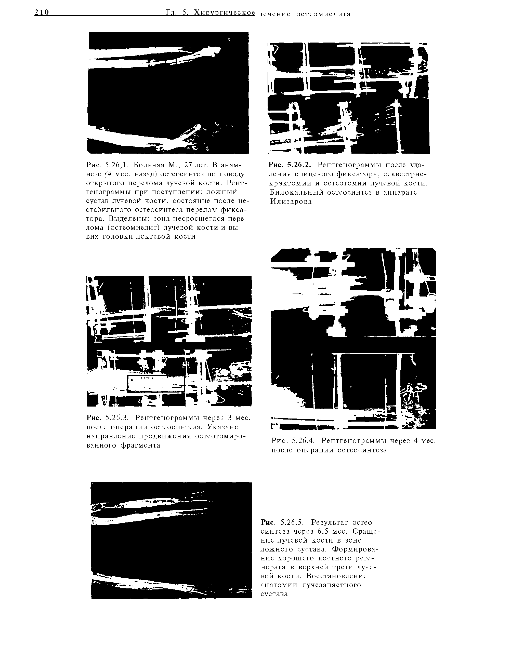 Рис. 5.26.2. Рентгенограммы после удаления спицевого фиксатора, секвестрне-крэктомии и остеотомии лучевой кости. Билокальный остеосинтез в аппарате Илизарова...