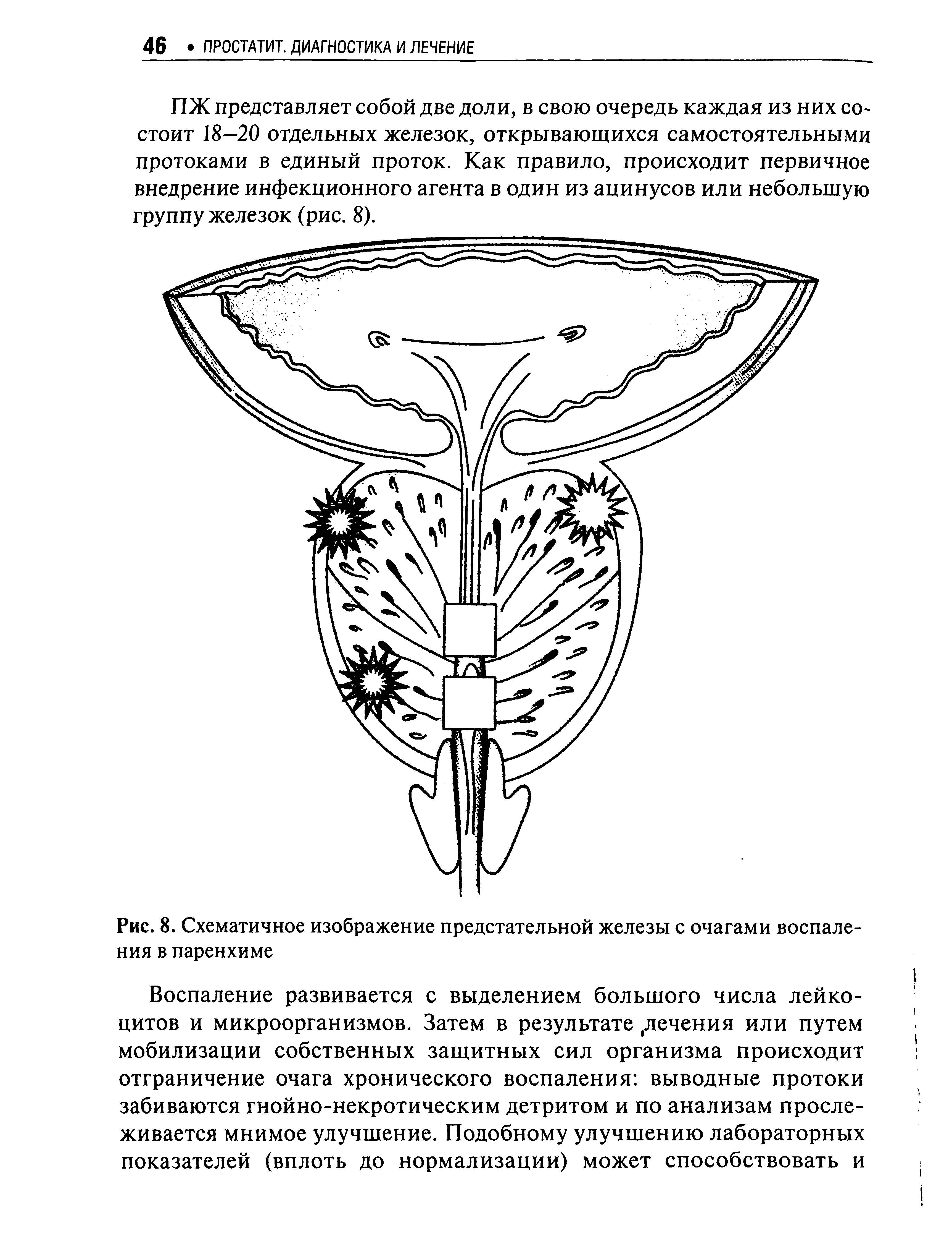 Рис. 8. Схематичное изображение предстательной железы с очагами воспаления в паренхиме...
