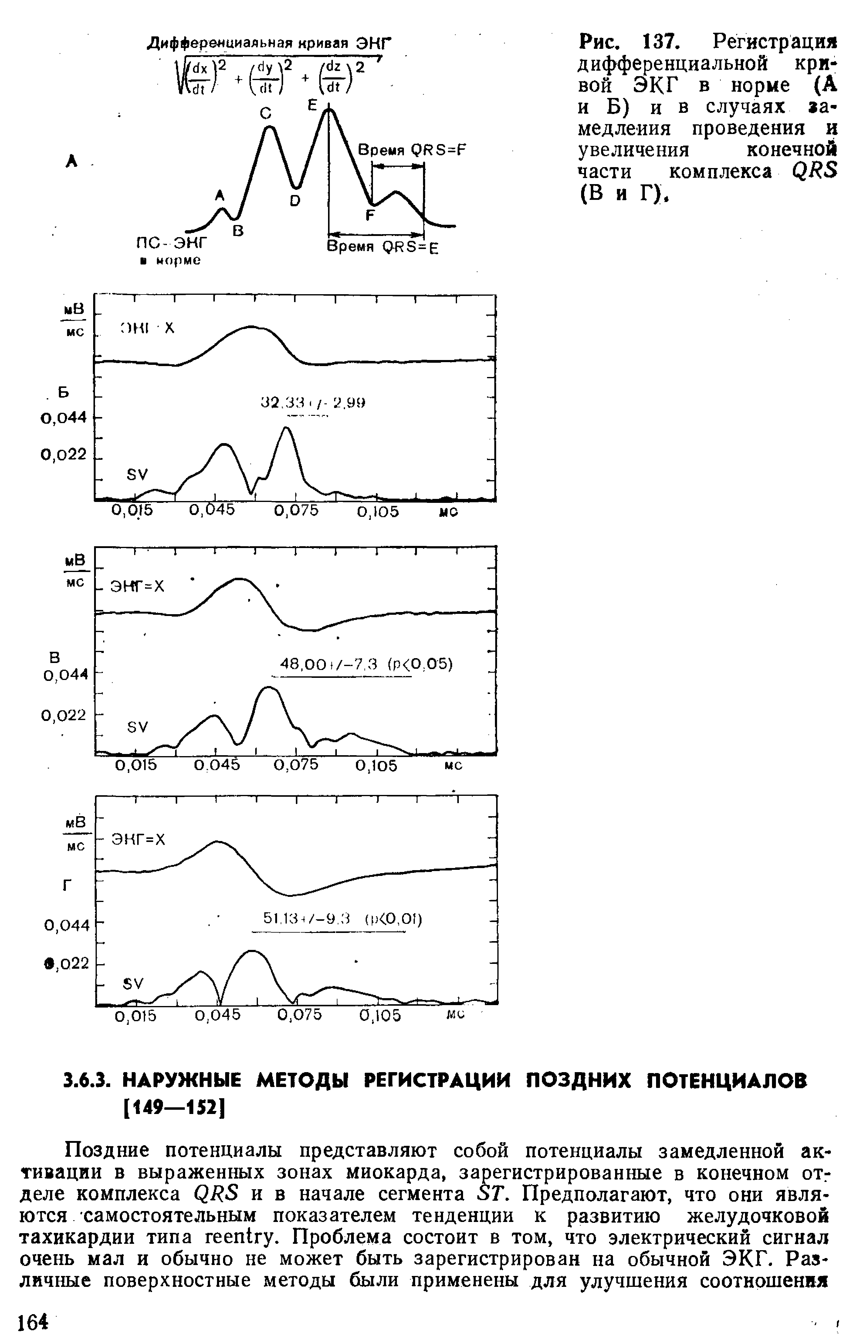 Рис. 137. Регистрация дифференциальной кривой ЭКГ в норме (А и Б) и в случаях аа-медлеиия проведения и увеличения конечной части комплекса...