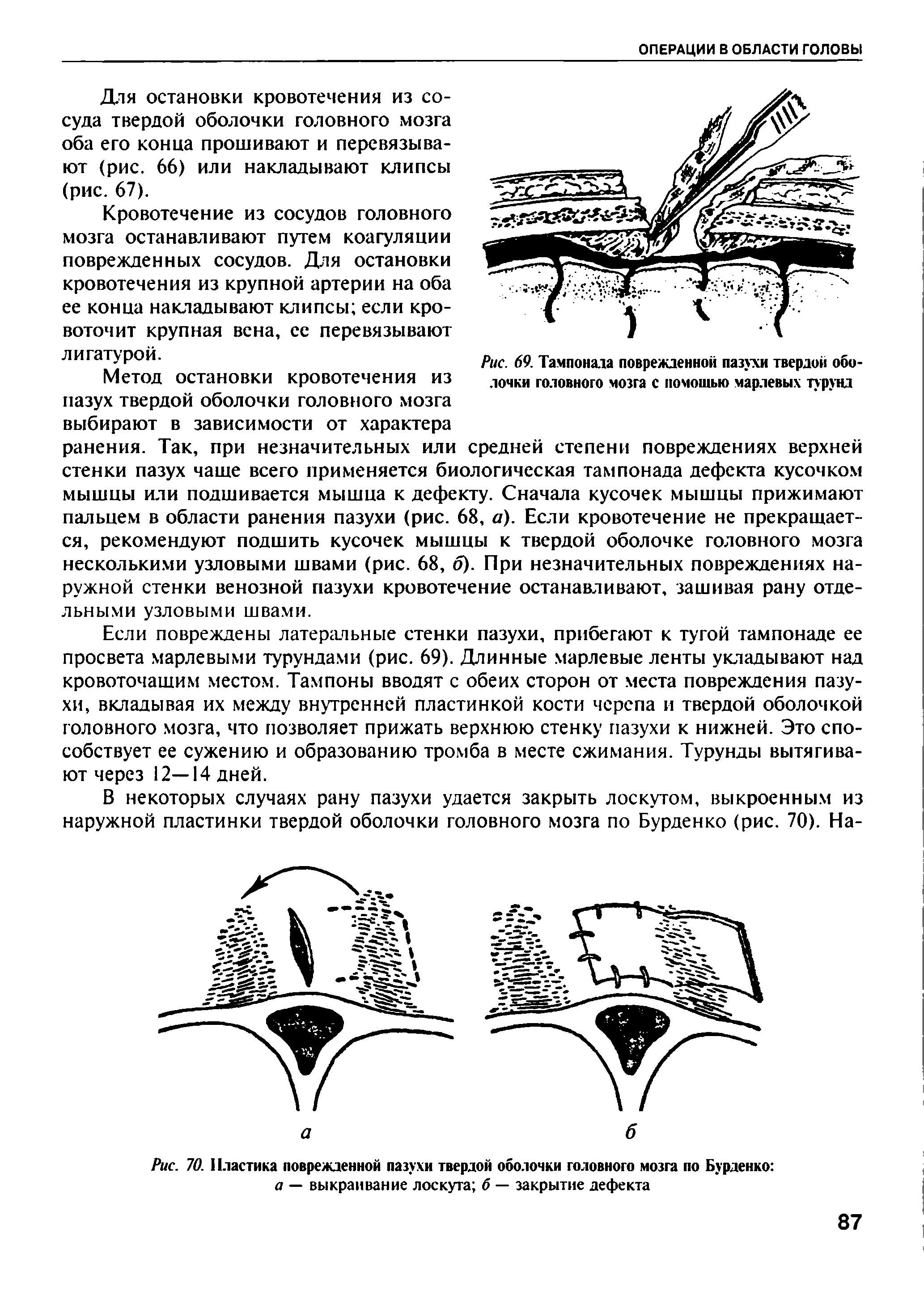 Рис. 70. Пластика поврежденной пазухи твердой оболочки головного мозга по Бурденко а — выкраивание лоскута б — закрытие дефекта...