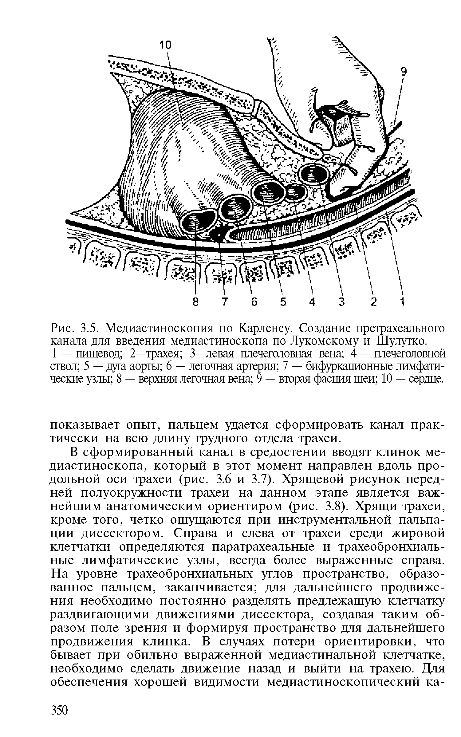 Рис. 3.5. Медиастиноскопия по Карленсу. Создание претрахеального канала для введения медиастиноскопа по Лукомскому и Шулутко.