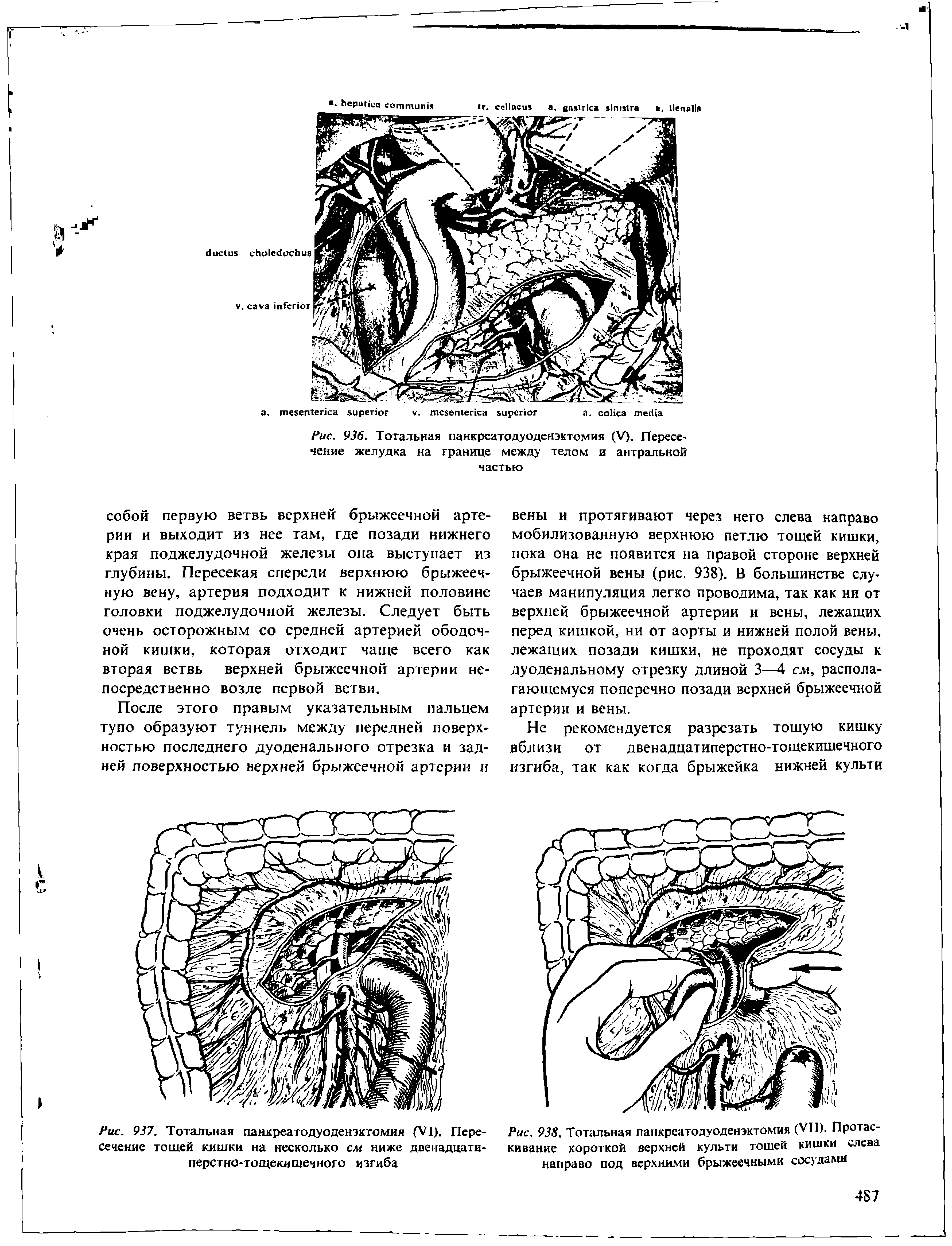 Рис. 937. Тотальная панкреатодуоденэктомия (VI). Пересечение тощей кишки на несколько см ниже двенадцатиперстно-тощекишечного изгиба...