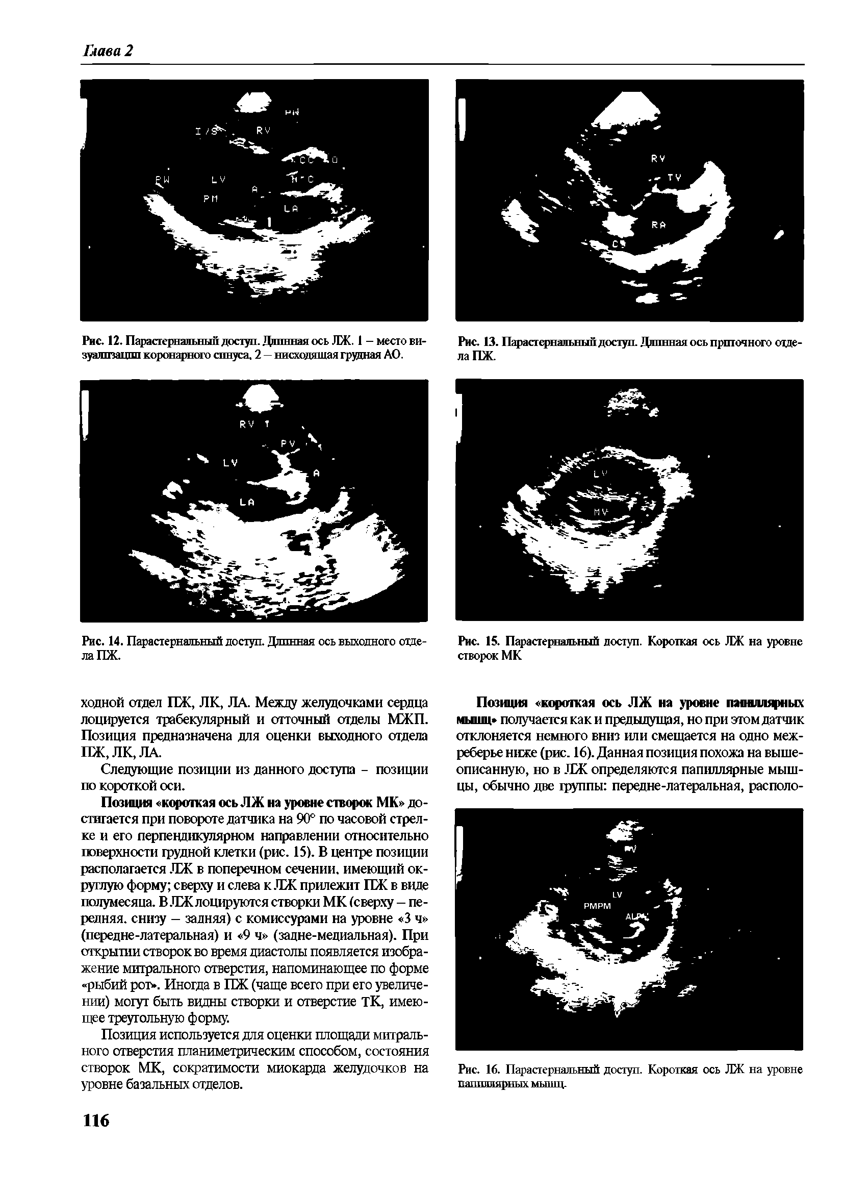 Рис. 12. Парастернальный доступ. Длинная ось ЛЖ. 1 -место визуализации коронарного синуса, 2 — нисходящая груцная АО.