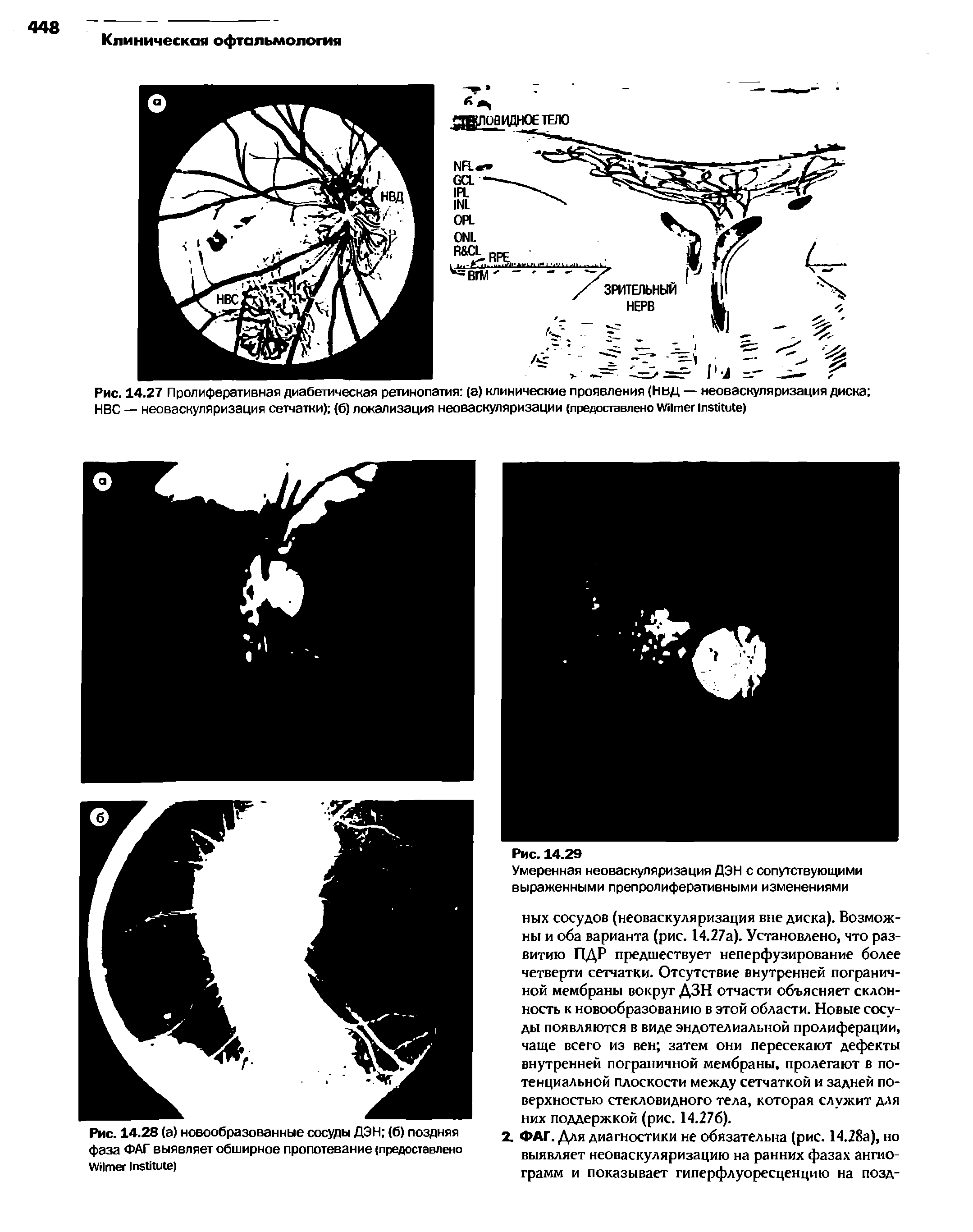 Рис. 14.27 Пролиферативная диабетическая ретинопатия (а) клинические проявления (Нвд — неоваскуляризация диска НВС — неоваскуляризация сетчатки) (б) локализация неоваскуляризации (предоставлено W )...