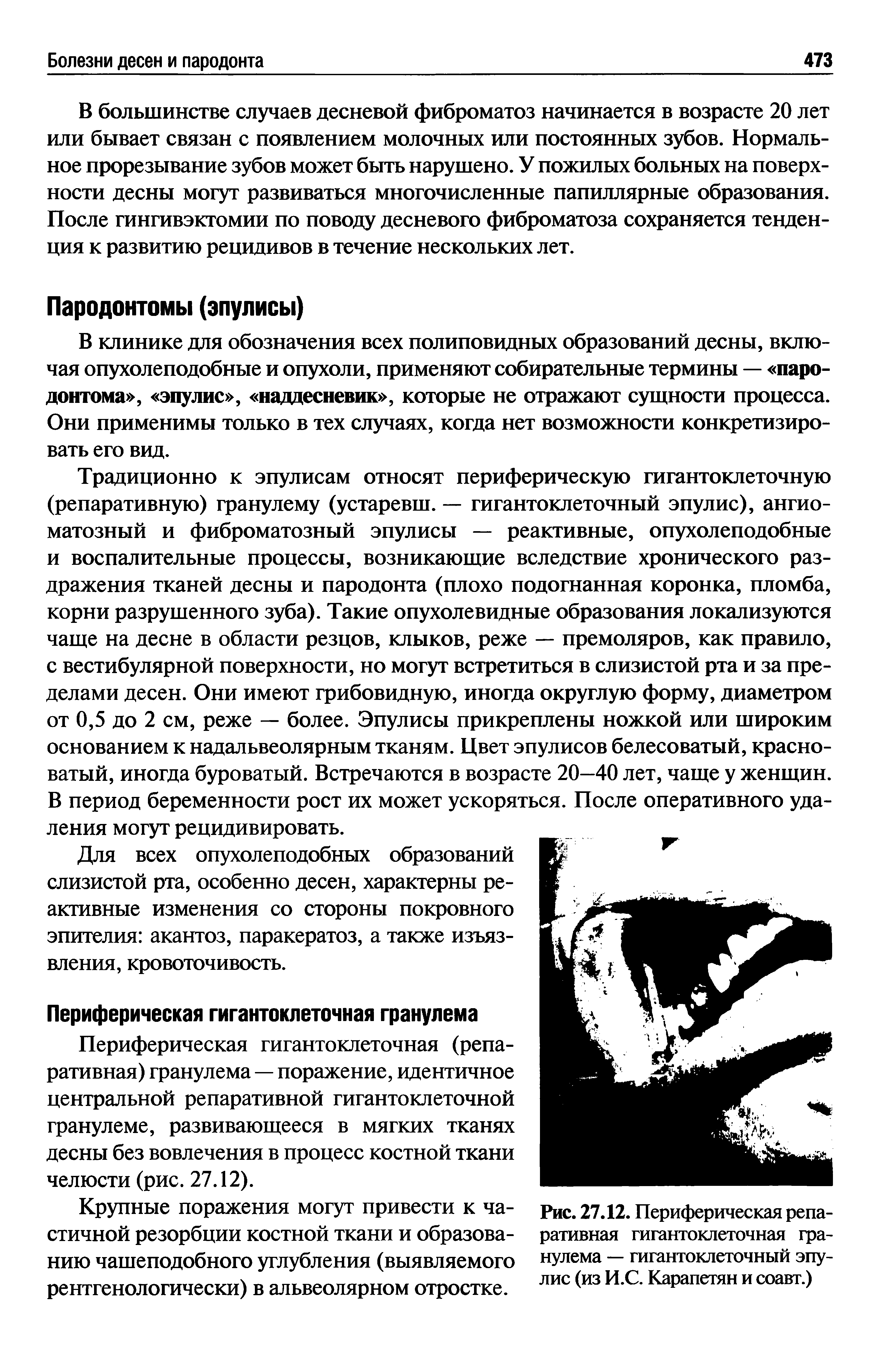 Рис. 27.12. Периферическая репаративная гигантоклеточная гранулема — гигантоклеточный эпулис (из И.С. Карапетян и соавт.)...