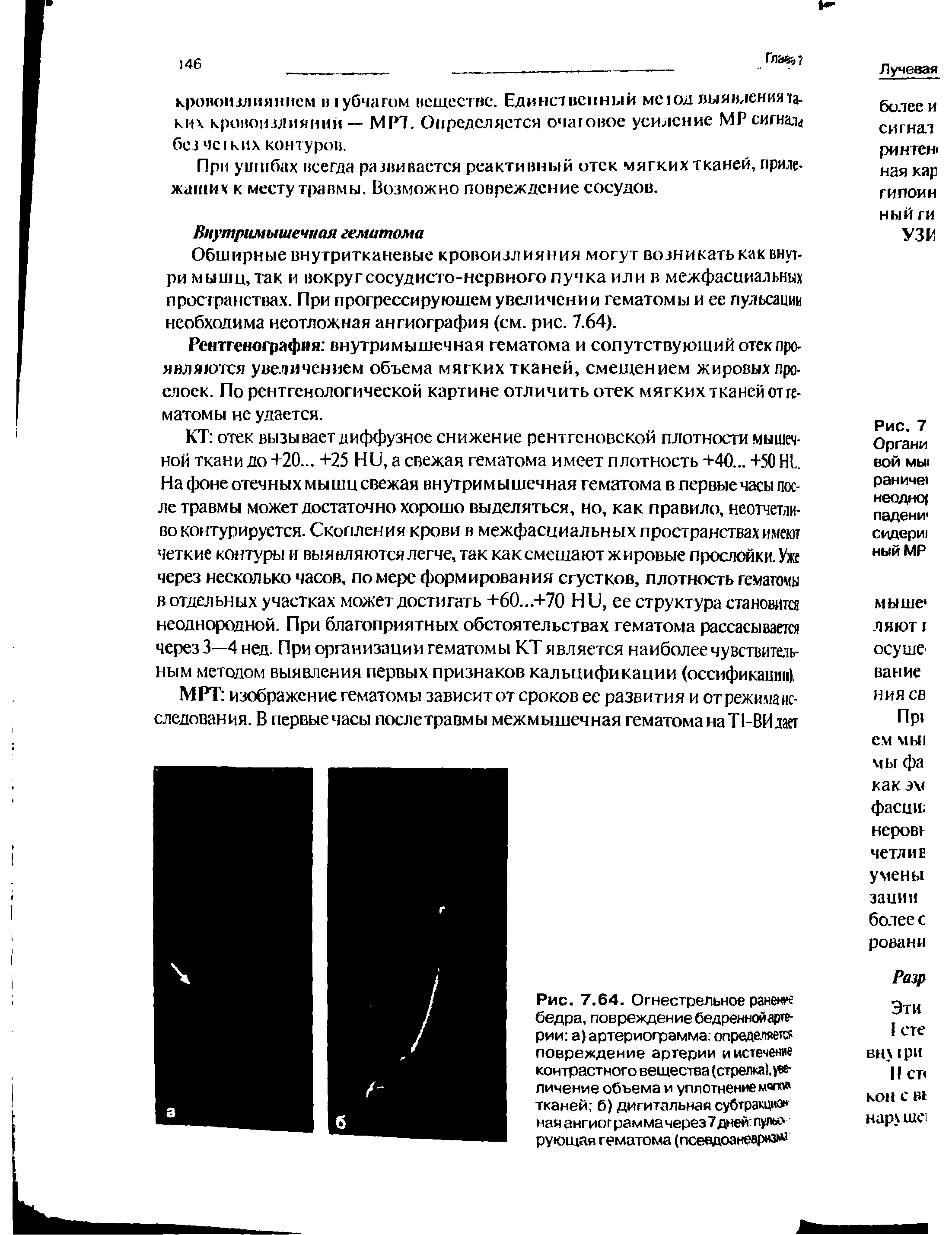 Рис. 7.64. Огнестрельное ранен бедра, повреждение бедренной артерии а) артериограмма определяется повреждение артерии и истечемте контрастного вещества (стрелка). -личение объема и уплотнение мяла тканей б) дигитальная субтракцно ная ангиограмма через7дней пулы рующая гематома (псевдоаневрнзке...