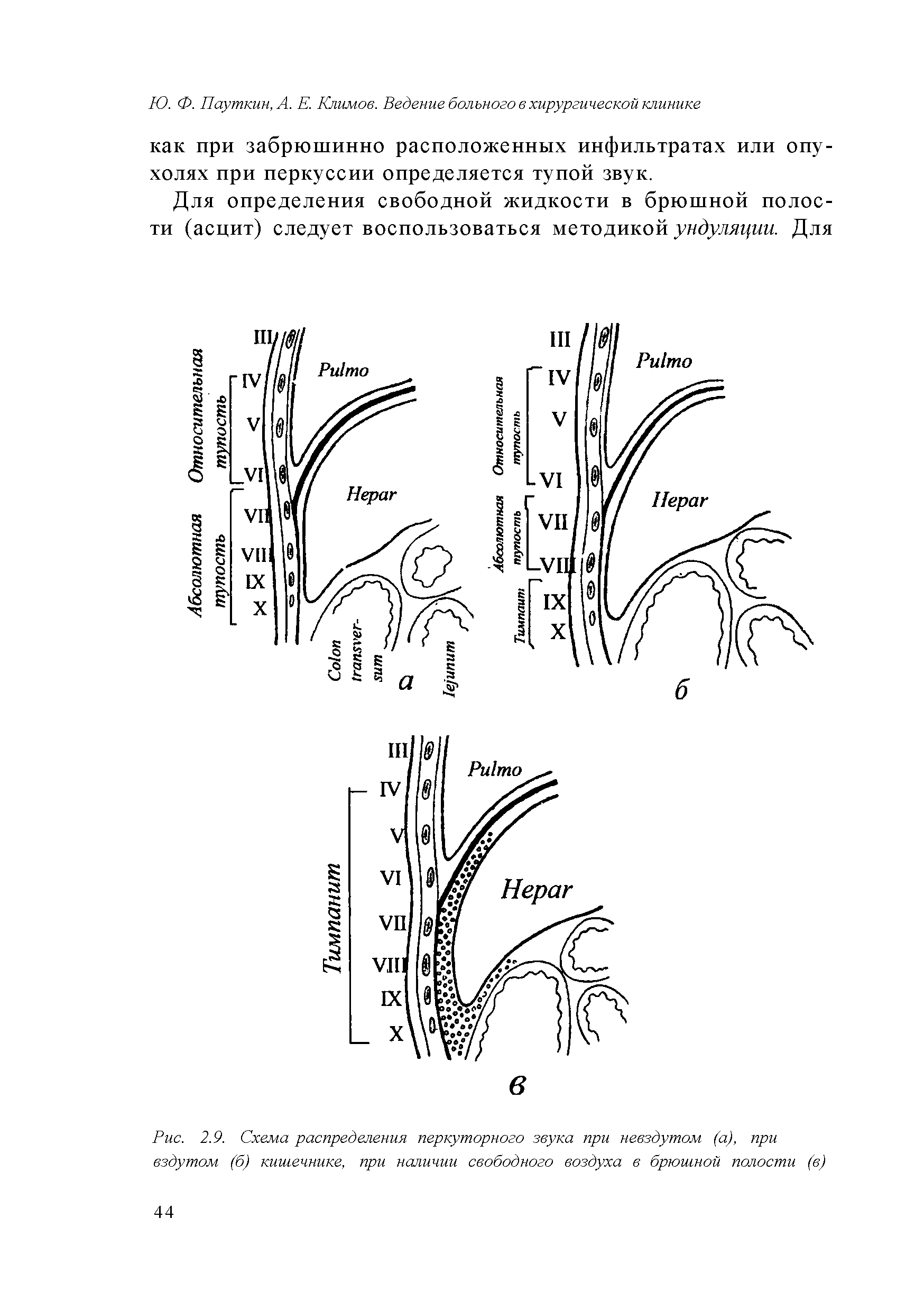 Рис. 2.9. Схема распределения перкуторного звука при невздутом (а), при вздутом (б) кишечнике, при наличии свободного воздуха в брюшной полости (в)...