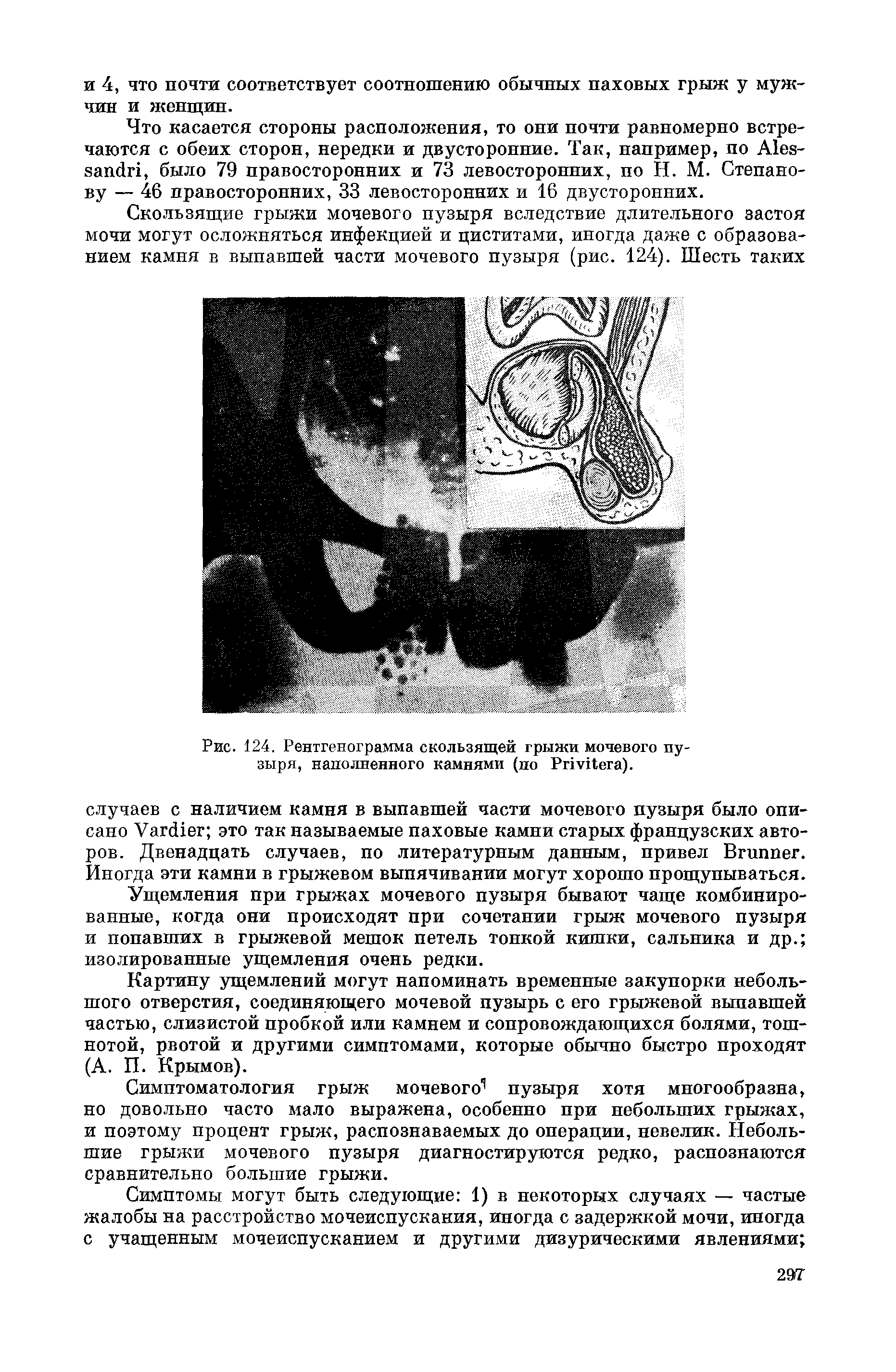 Рис. 124. Рентгенограмма скользящей грыжи мочевого пузыря, наполненного камнями (по РпуЛега).